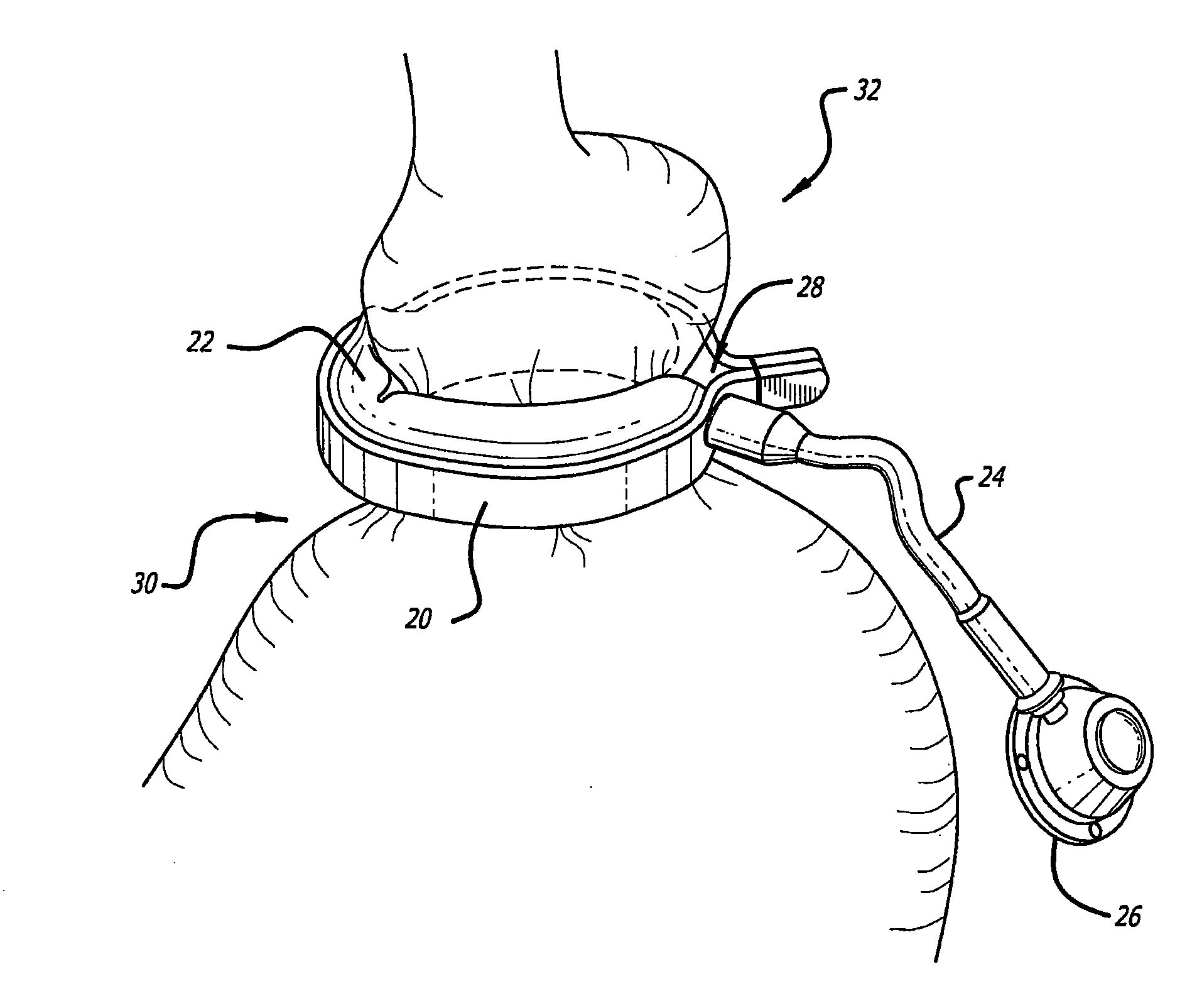 Assembly and method for automatically controlling pressure for a gastric band