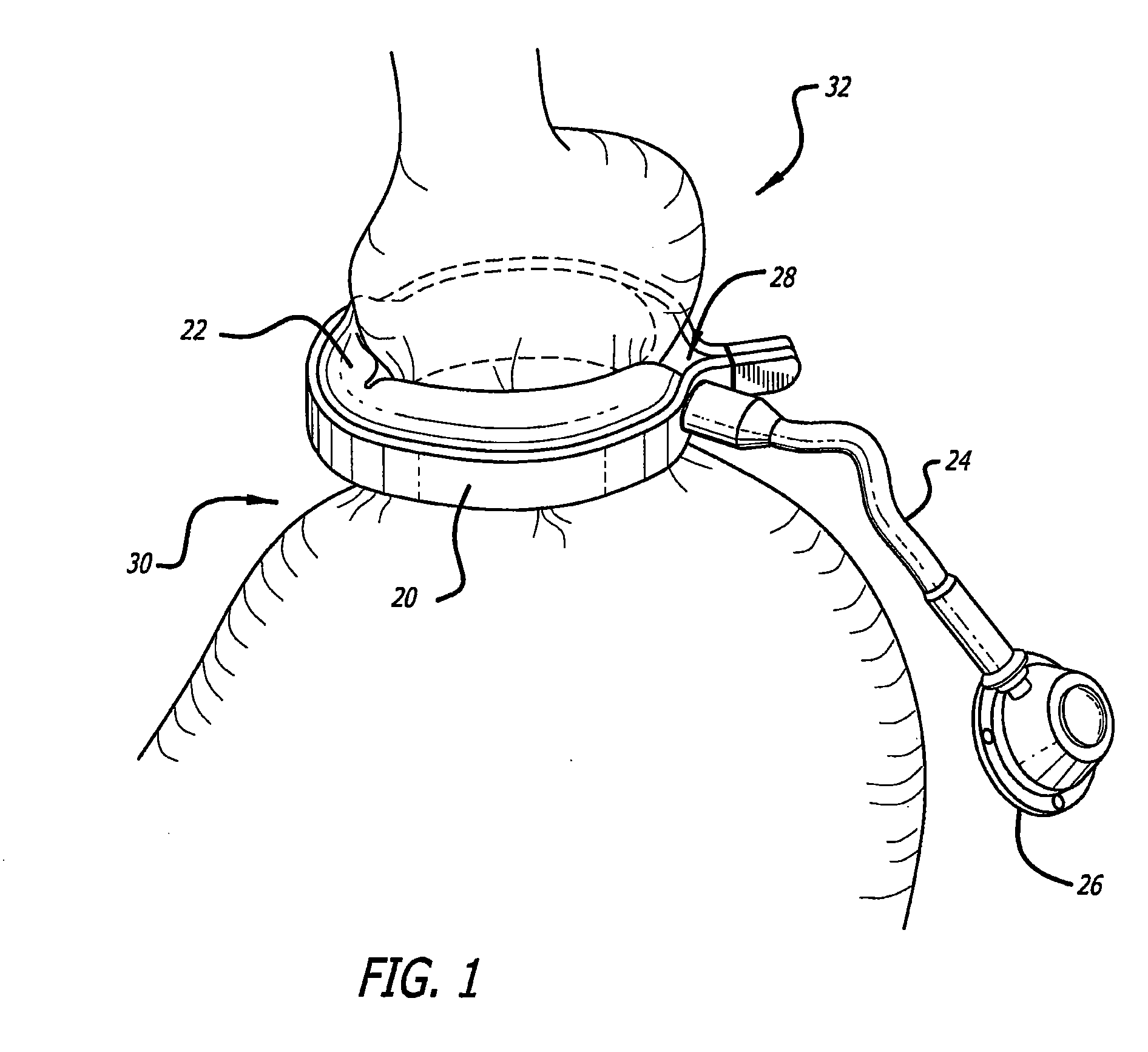 Assembly and method for automatically controlling pressure for a gastric band