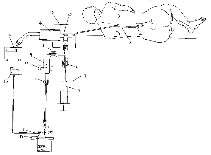 Monitoring and therapeutic apparatus for draining and displacing cerebrospinal fluid and pressurizing