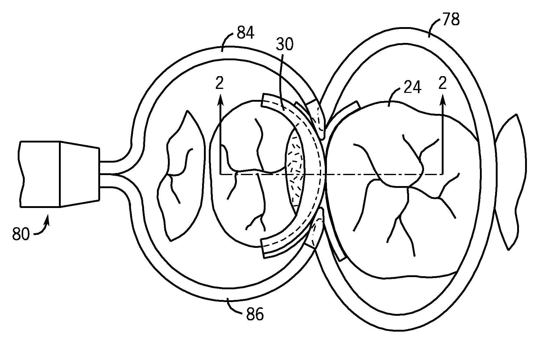 Devices And A Seamless, Single Load, Injection Molded Cavity Preparation And Filling Technique