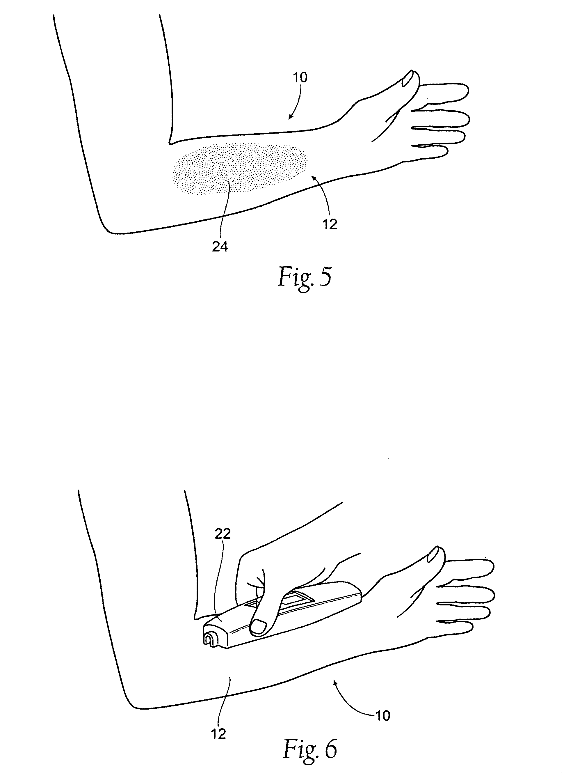 Assemblies, systems, and methods for skin treatment incorporating oxidized cellulose