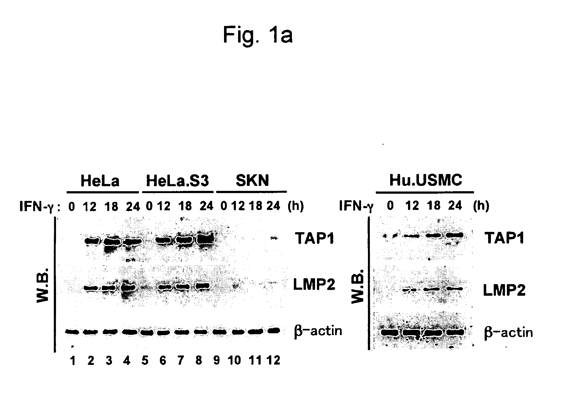 Detection of uterine leiomyosarcoma using lmp2