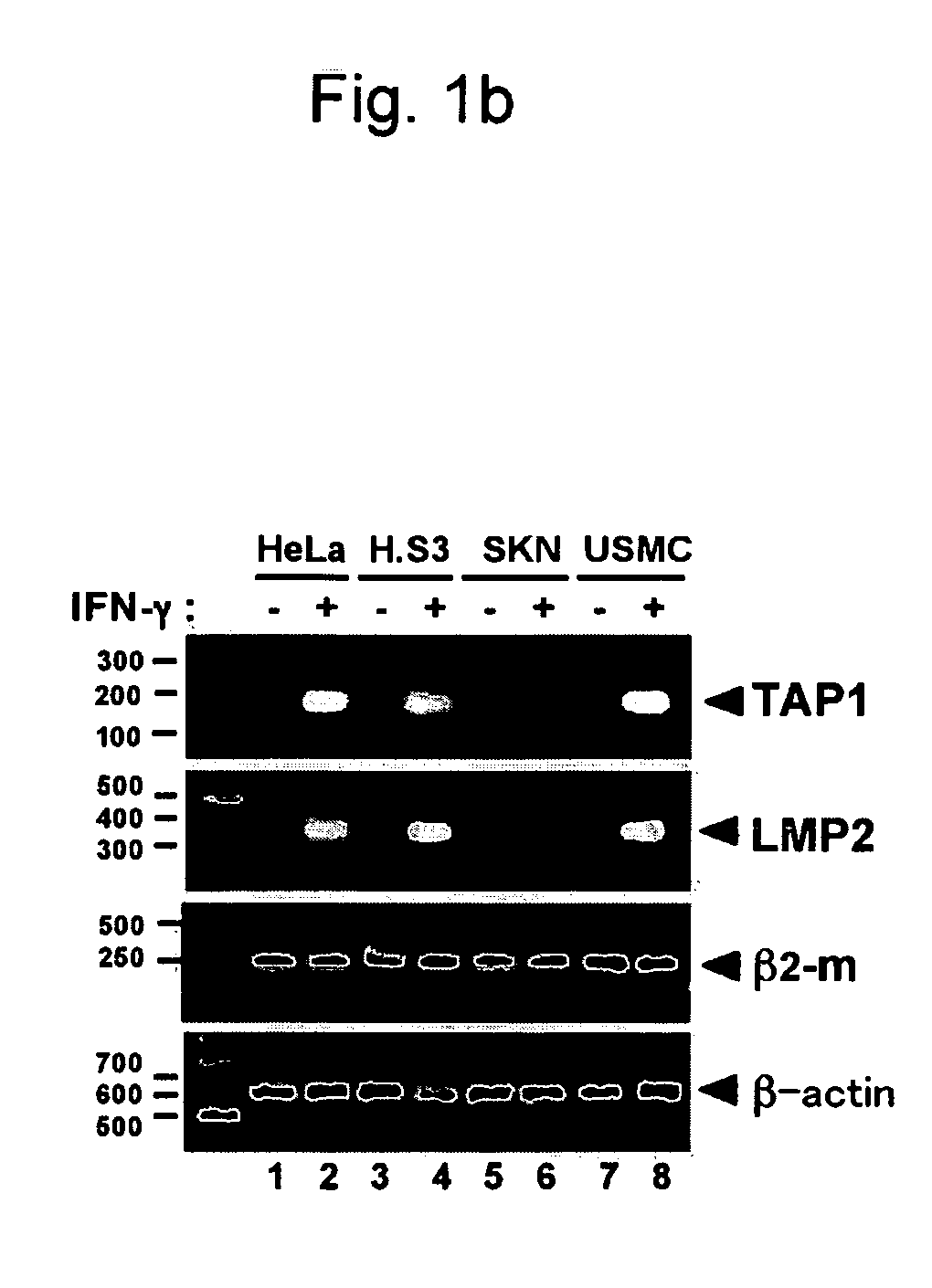 Detection of uterine leiomyosarcoma using lmp2