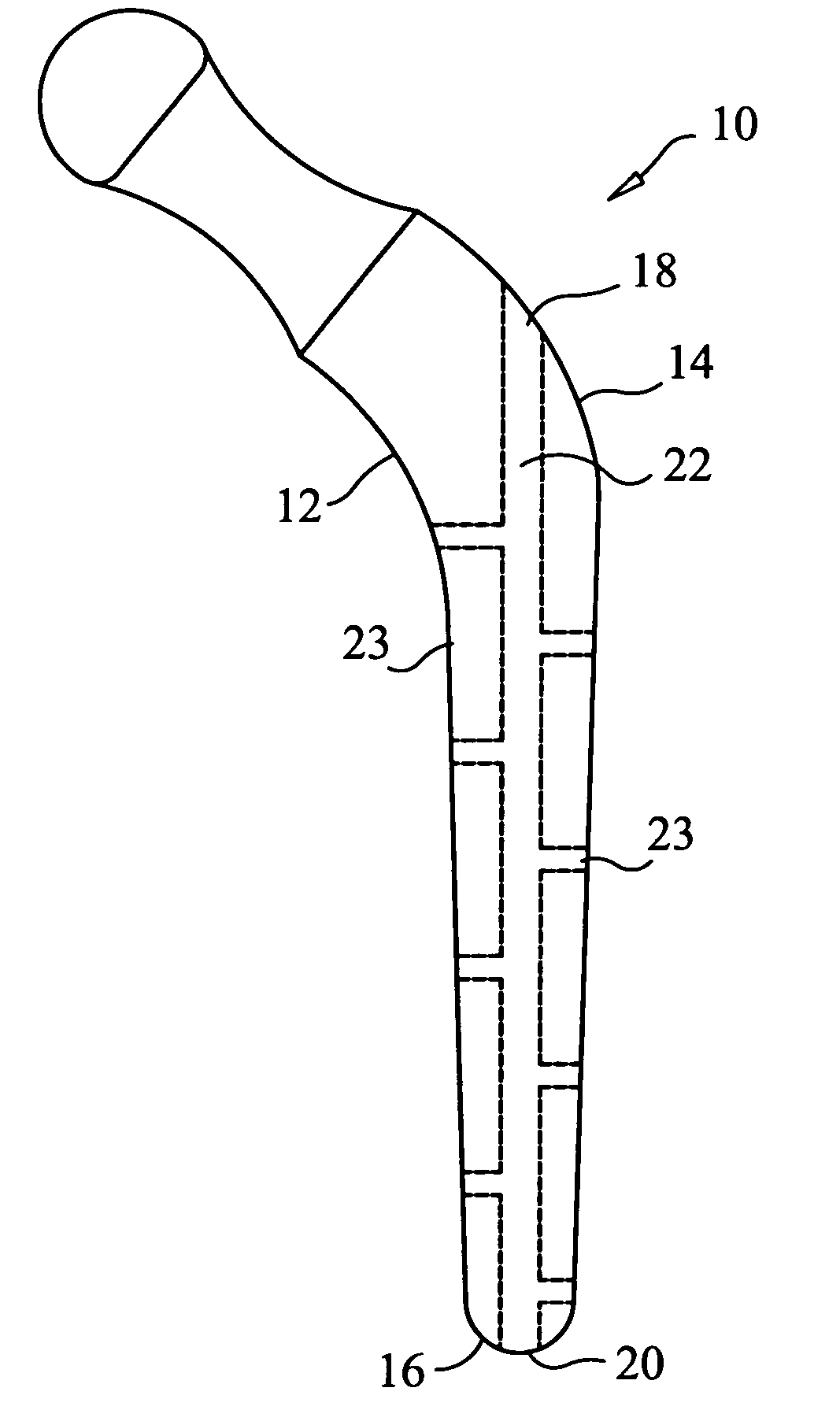 Canulized prosthesis for total hip replacement surgery