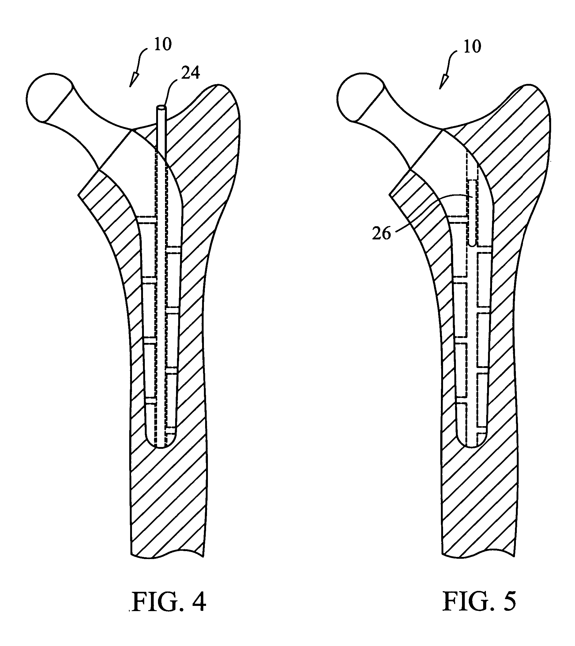 Canulized prosthesis for total hip replacement surgery