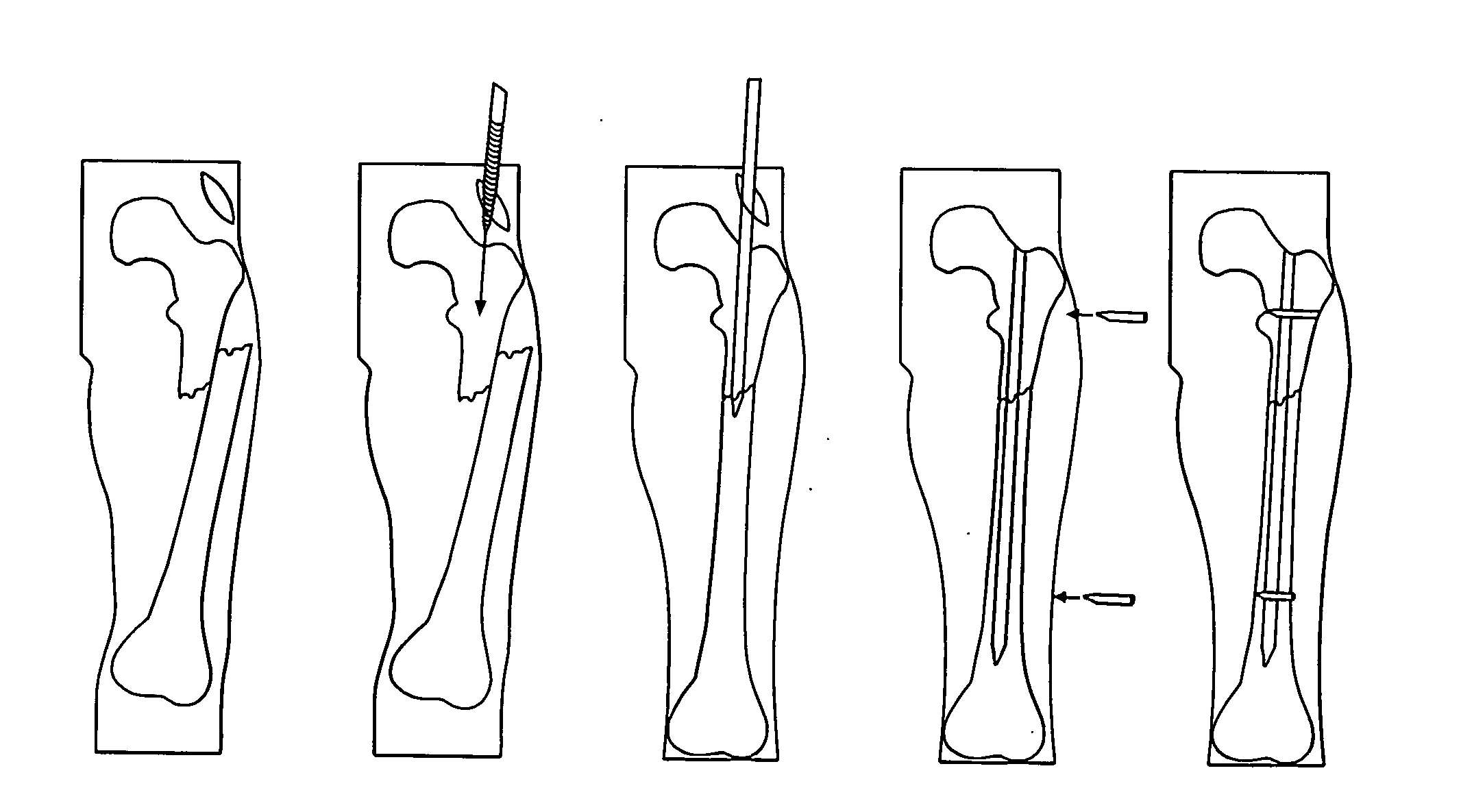 Osteosynthetic shape memory material intramedullary bone stent and method for treating a bone fracture using the same