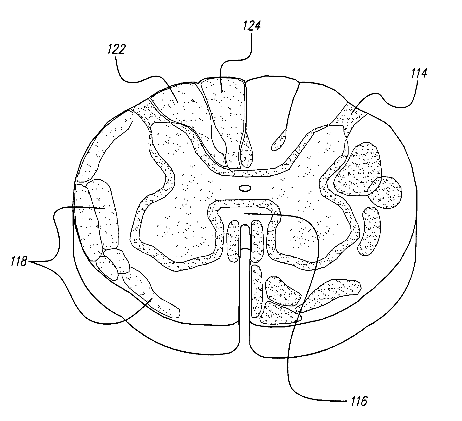 Methods for implanting a spinal cord stimulator