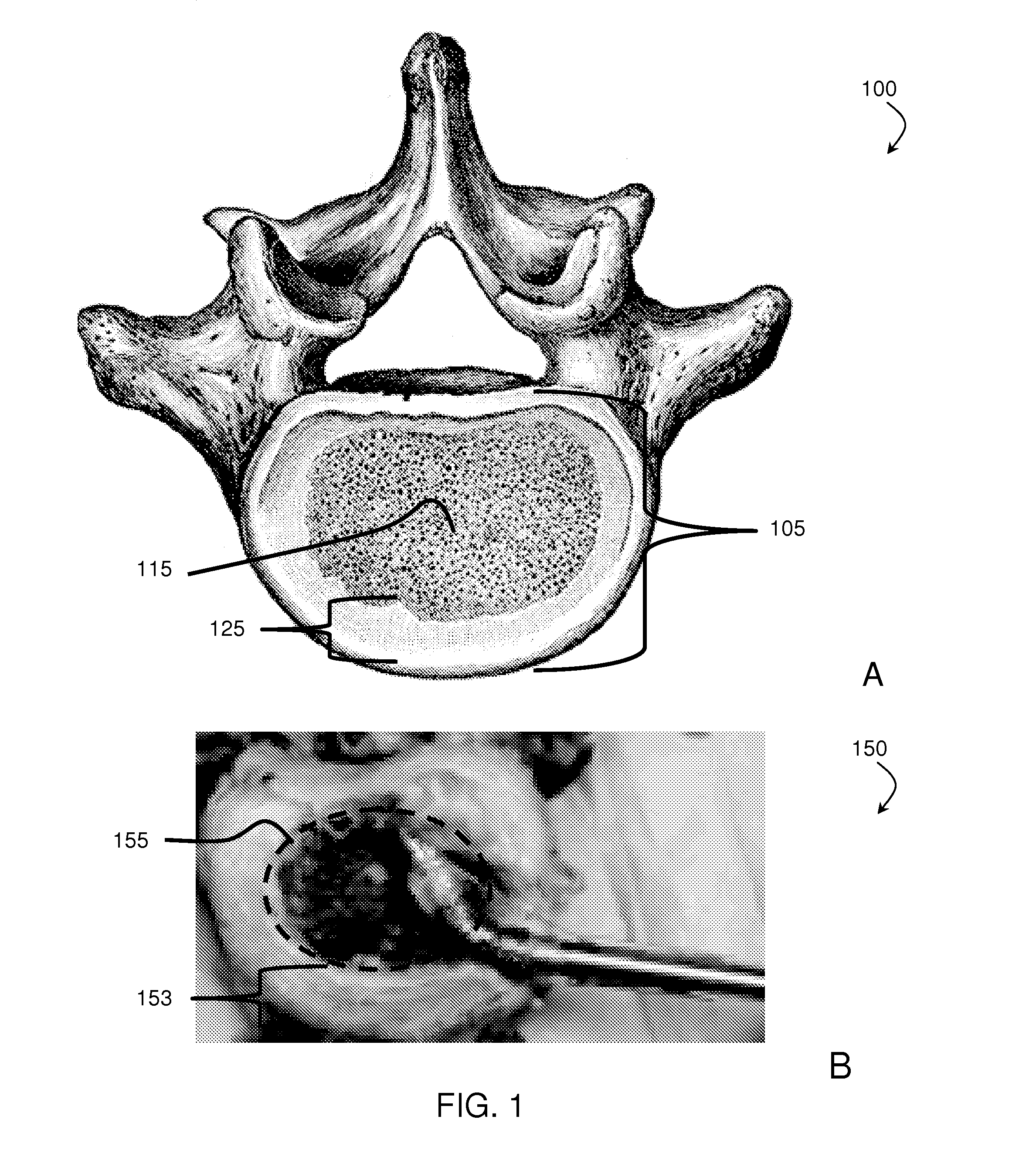 Staged, bilaterally expandable trial