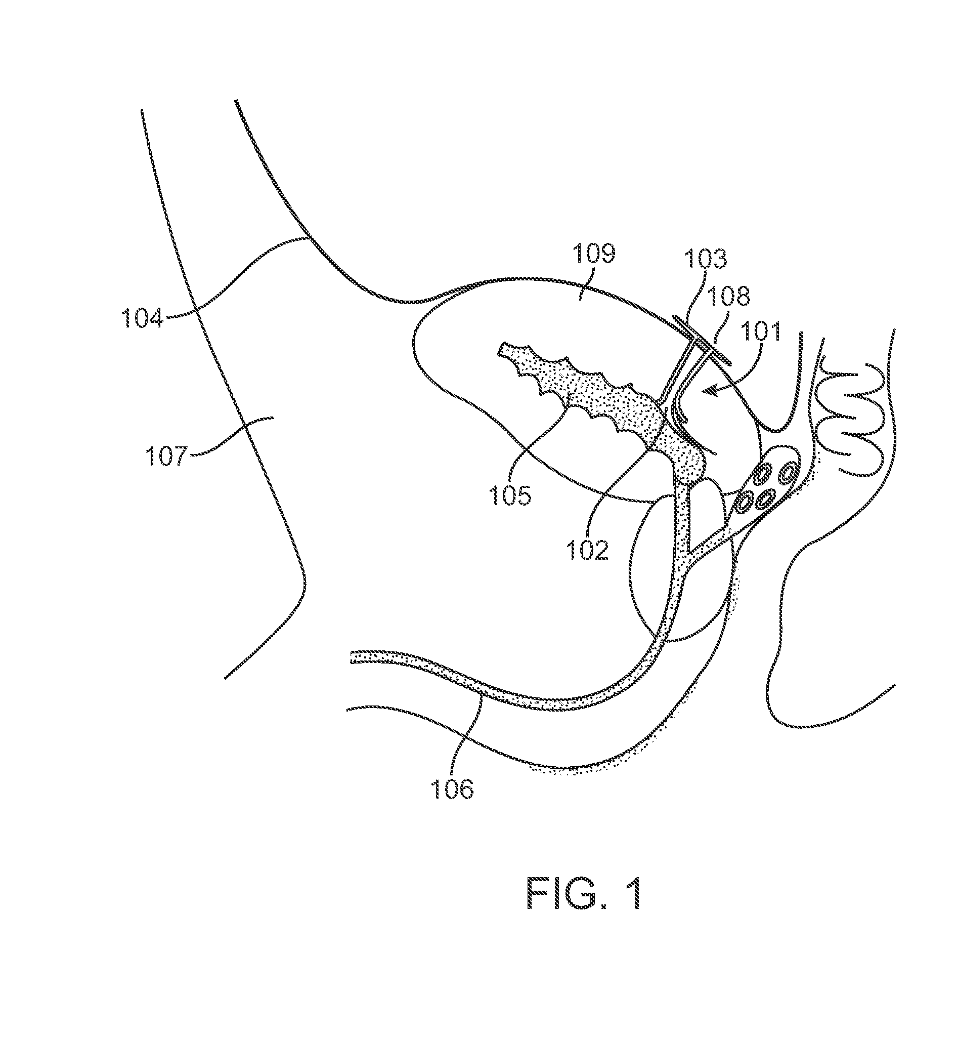 Peritoneal drain and infusion