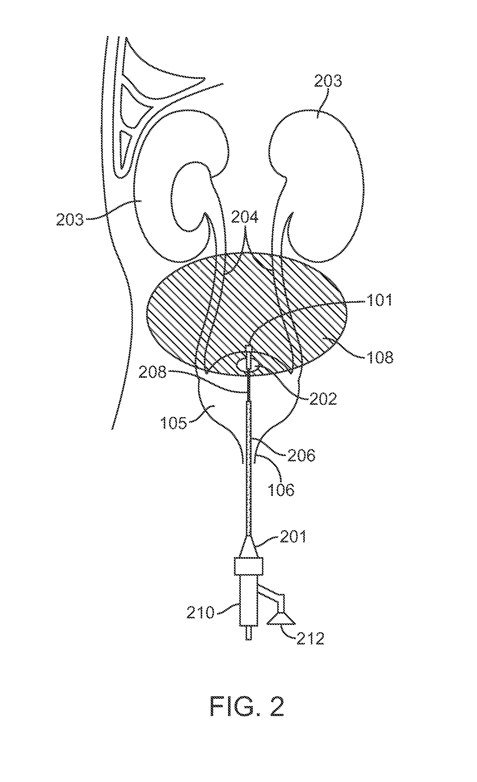 Peritoneal drain and infusion