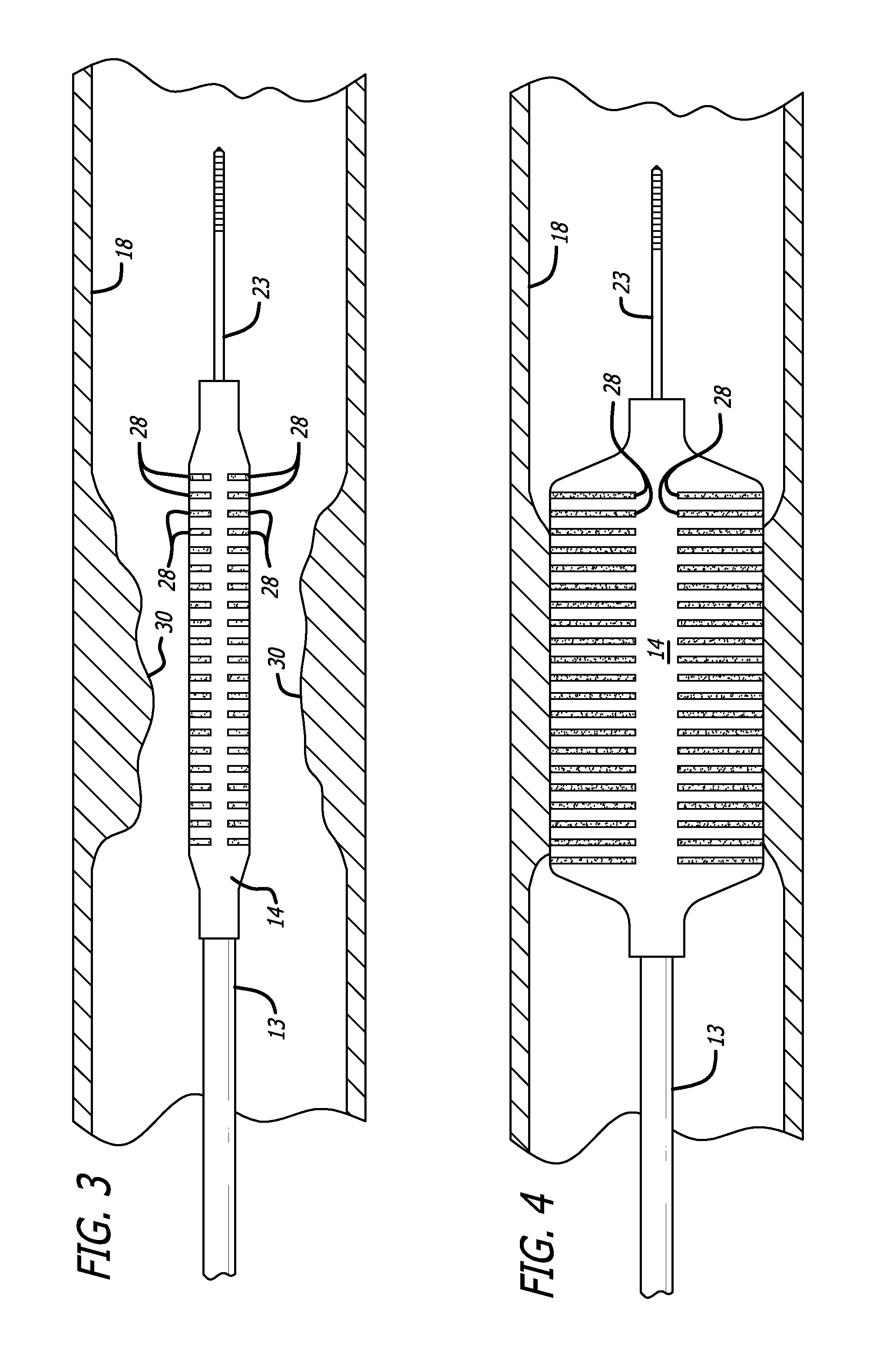 Delivery system with incremental markers