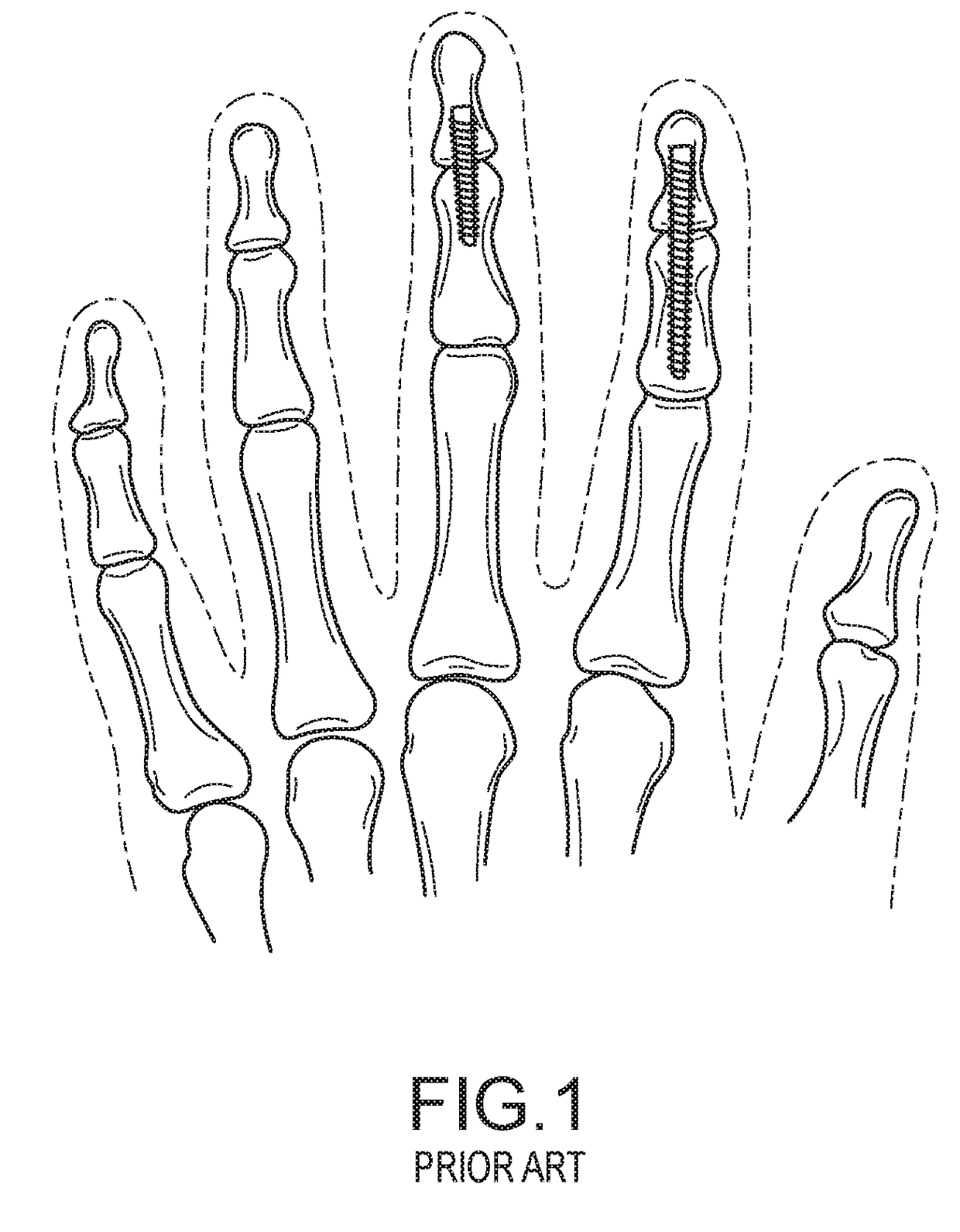 Dip fusion spike screw