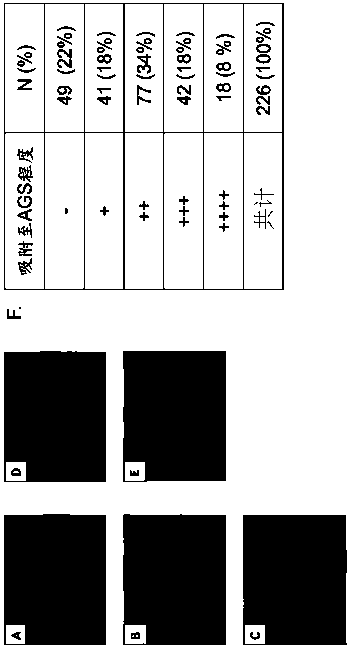 Lactobacillus composition for inhibiting gastritis caused by helicobacter pylori in stomach and application thereof