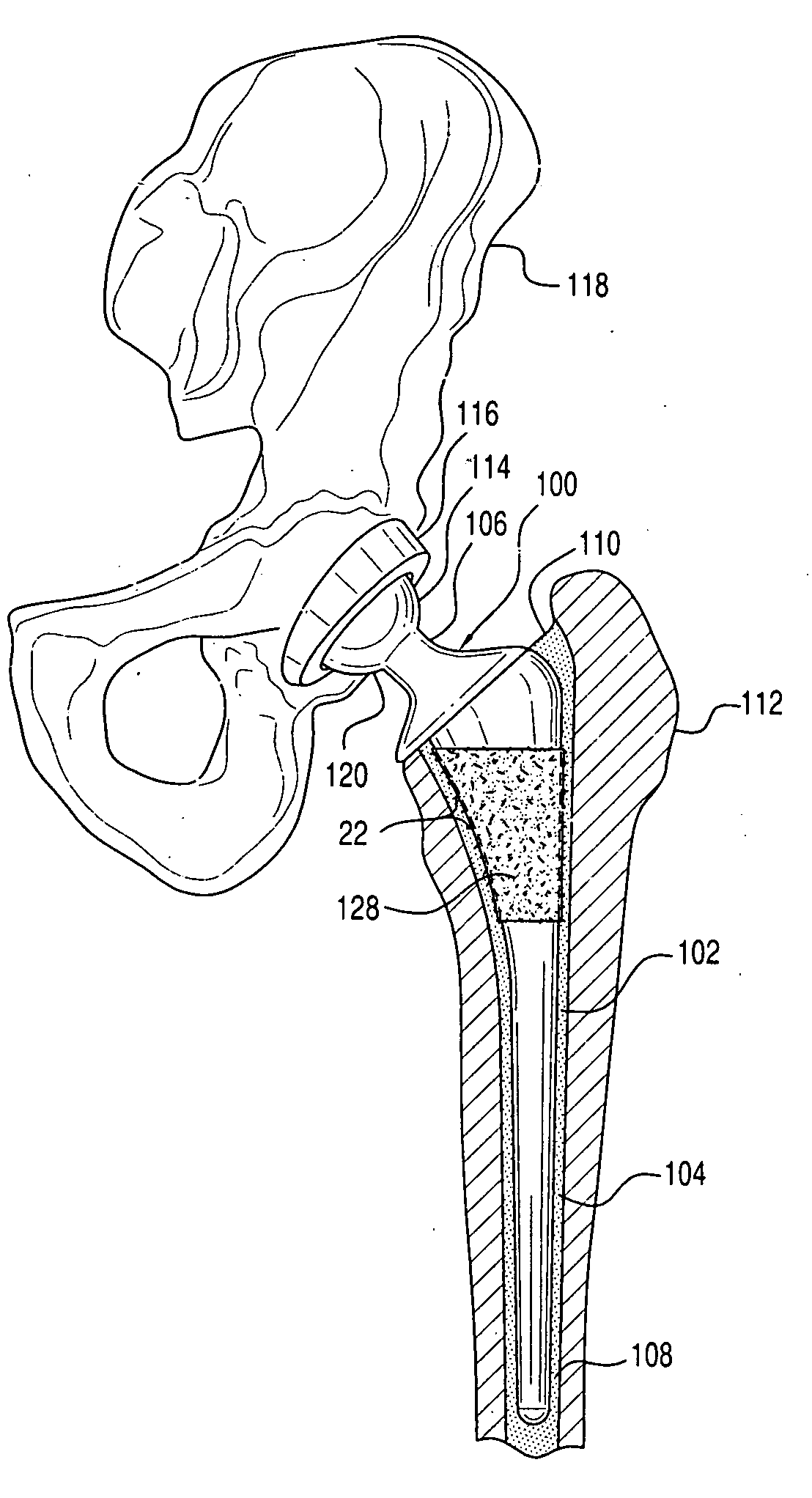 Bone graft composition, method and implant