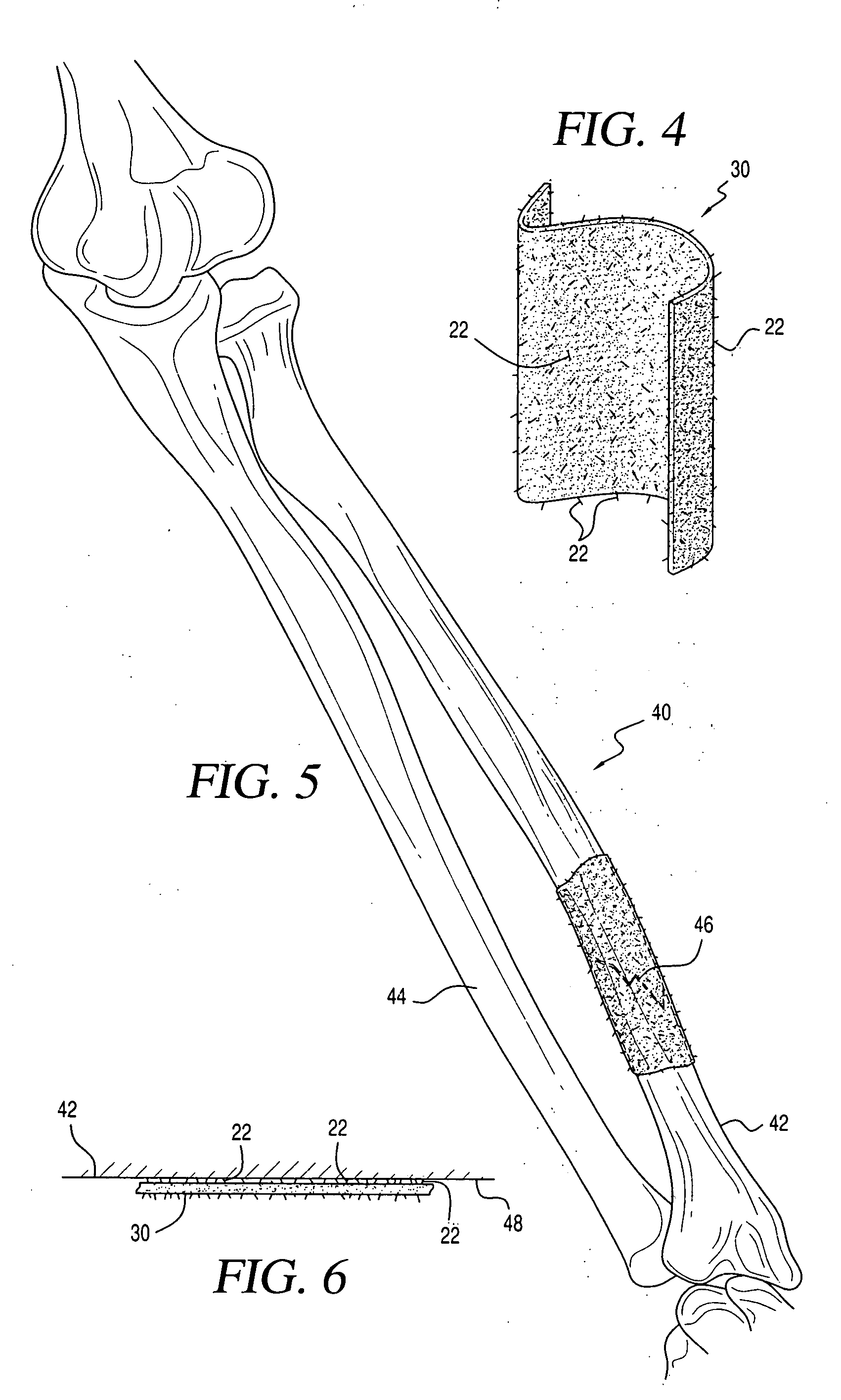 Bone graft composition, method and implant