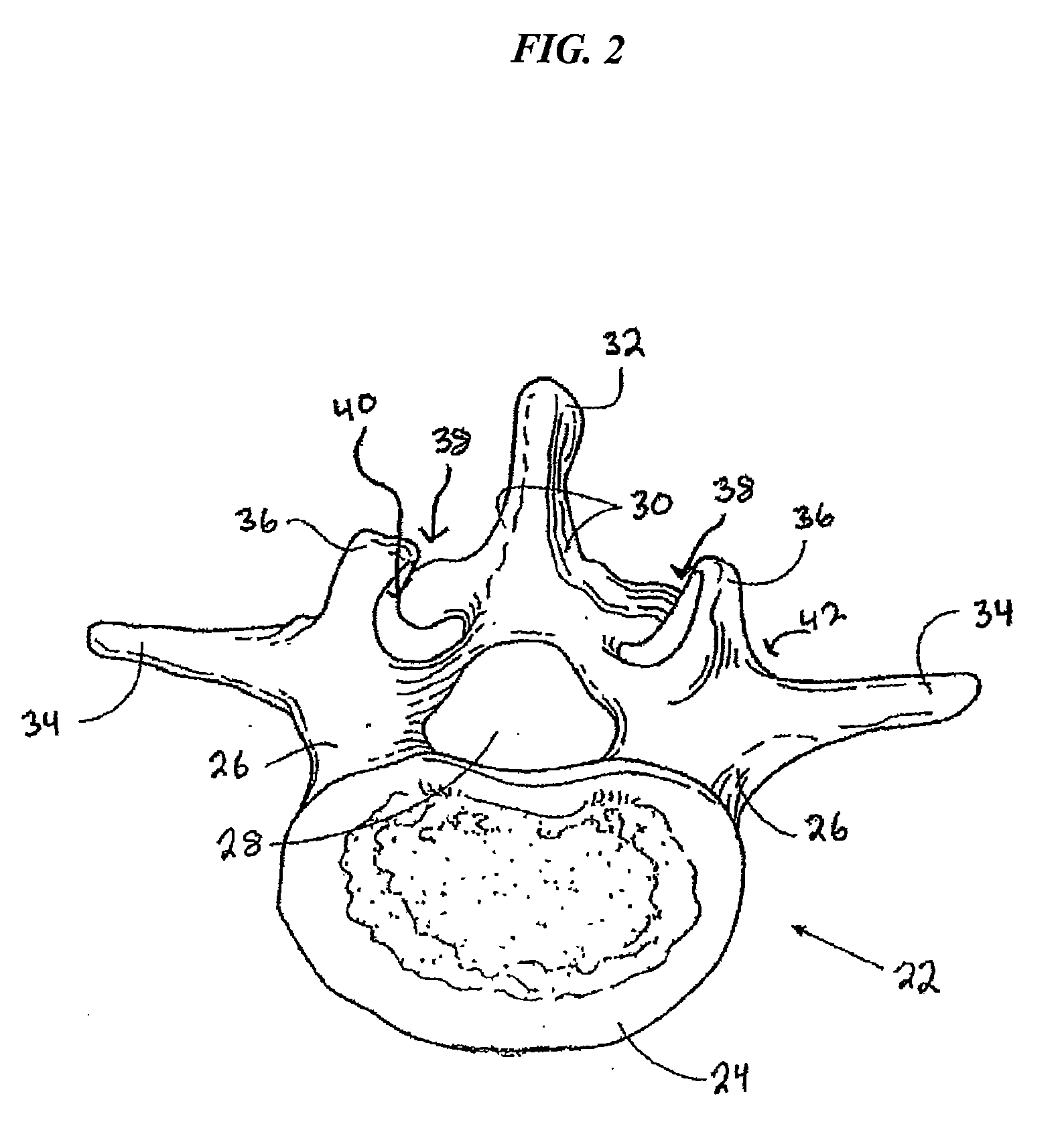 Articulating facet fusion screw