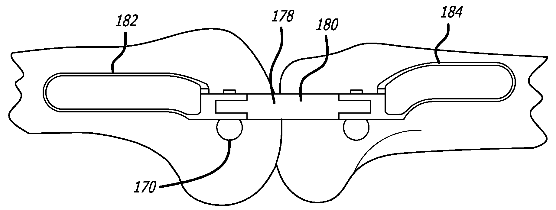 Surgical implantation method and devices for an extra-articular mechanical energy absorbing apparatus