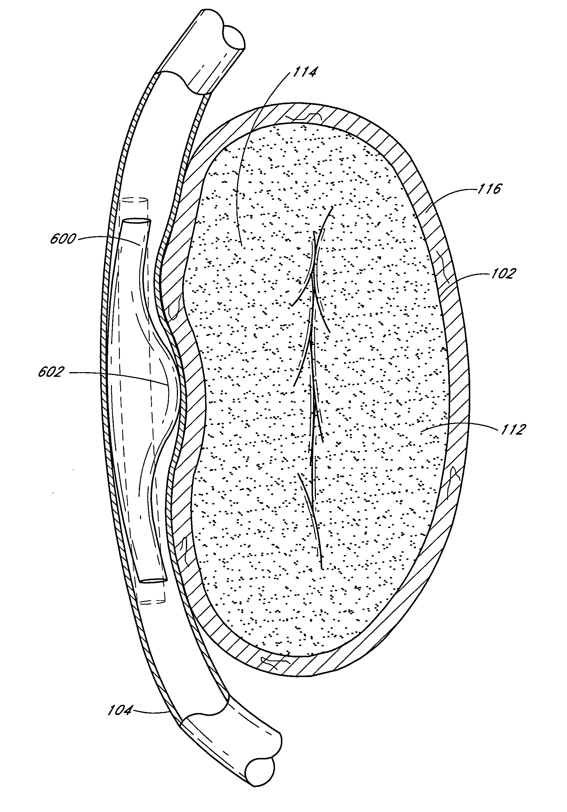 Dynamically adjustable implants and methods for reshaping tissue