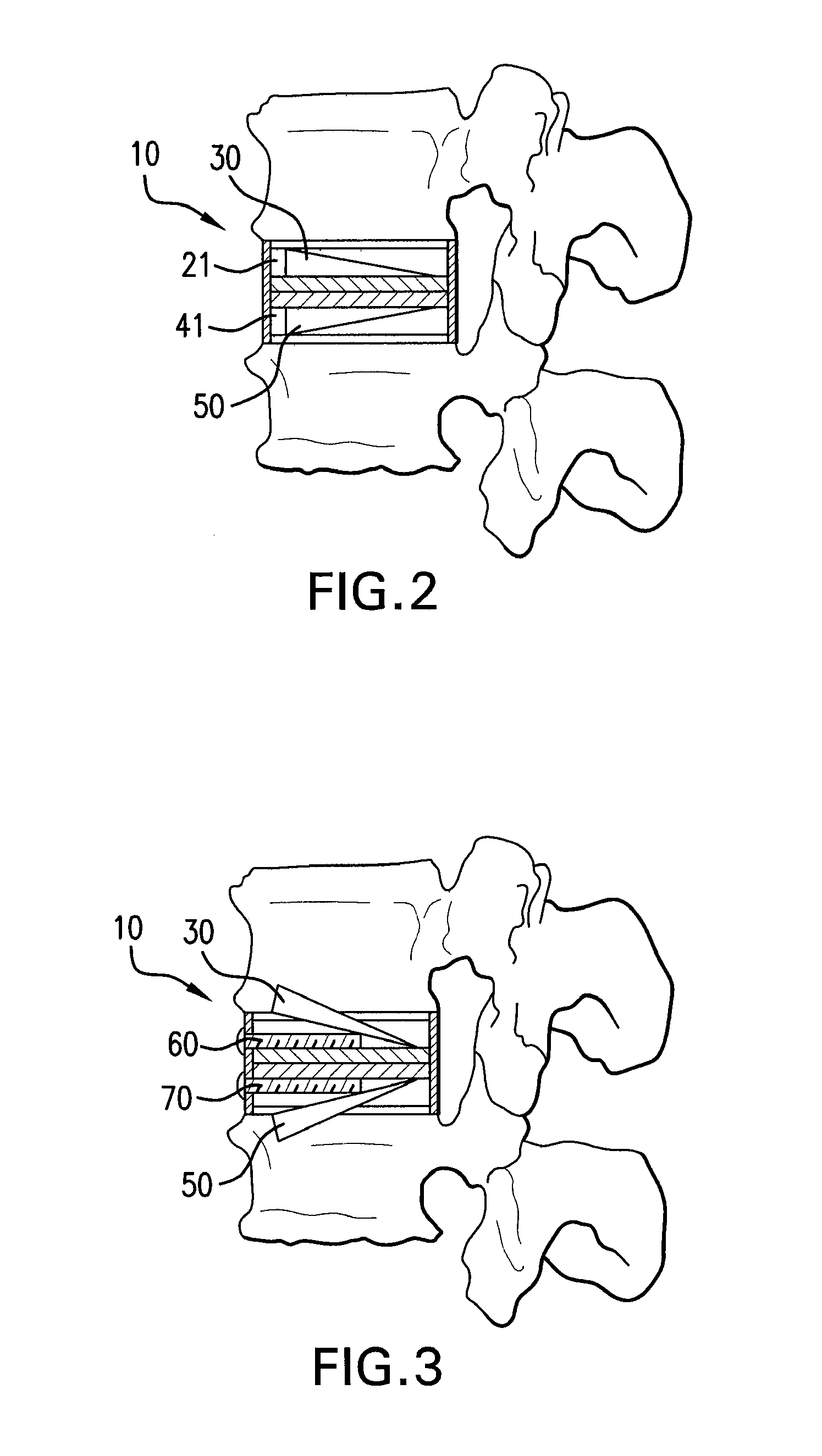 Modular intervertebral disc prosthesis and method of replacing an intervertebral disc