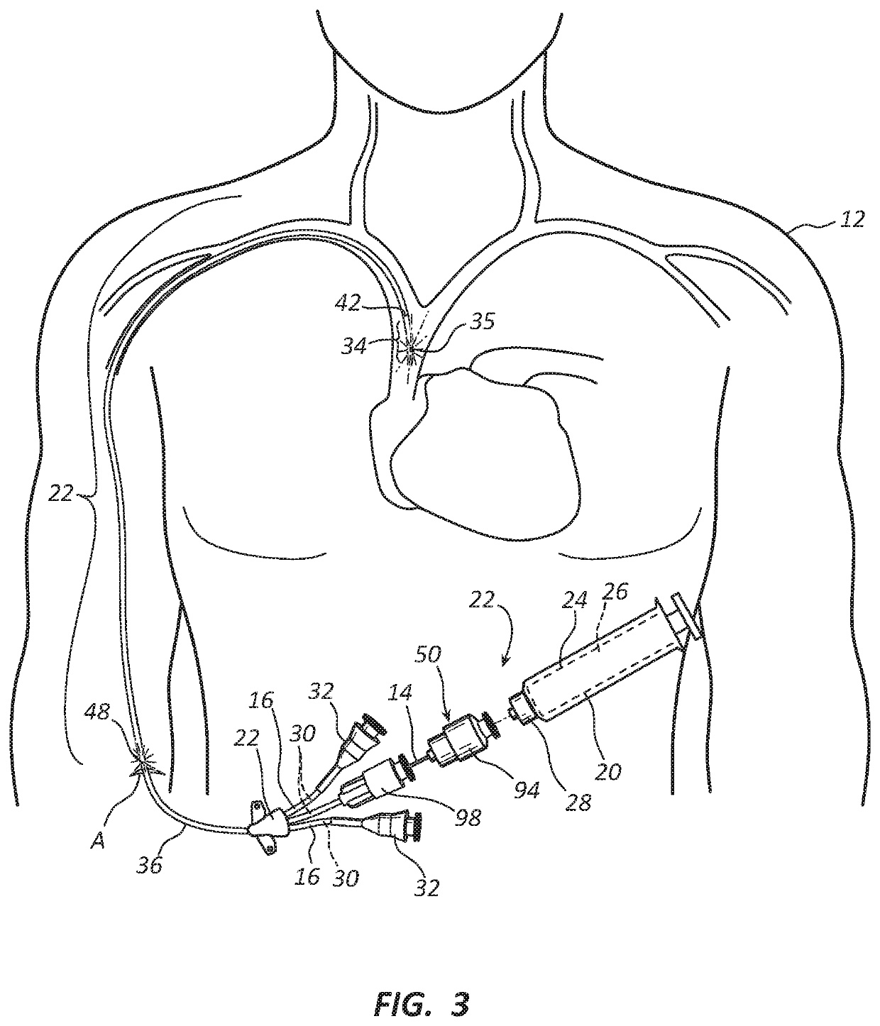 Methods and apparatus to deliver therapeutic, non-ultraviolet electromagnetic radiation versatilely via a catheter residing in a body cavity