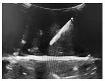 Phantom model for simulating clinical tumor thermal ablation treatment