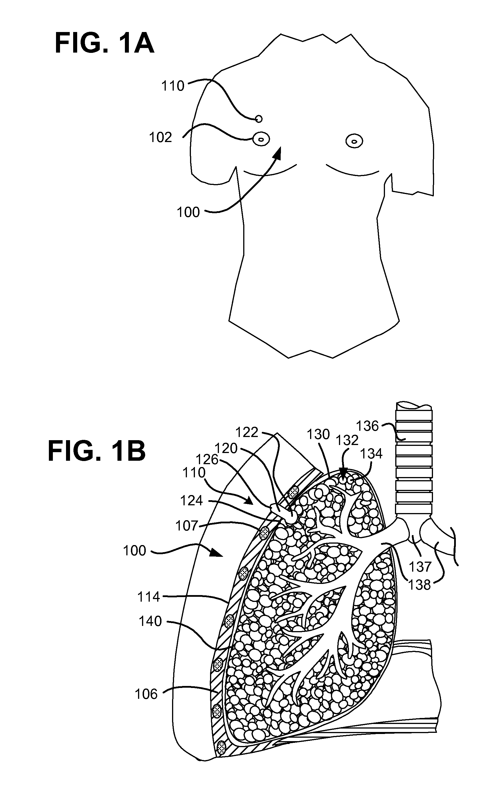 Pneumostoma management device and method for treatment of chronic obstructive pulmonary disease