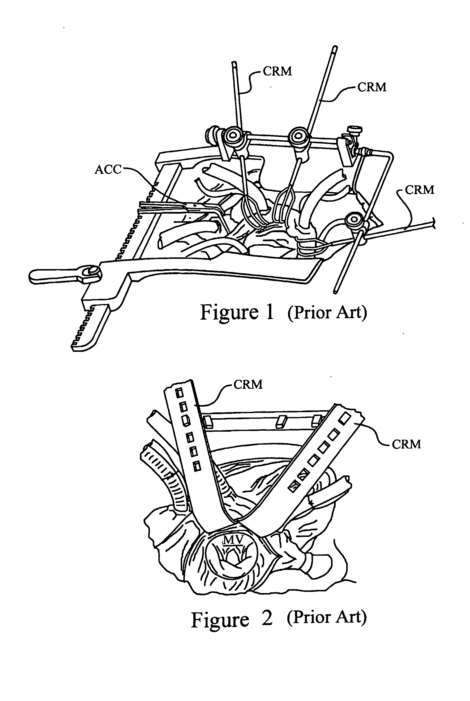 Adaptable tissue retractor with plurality of movable blades