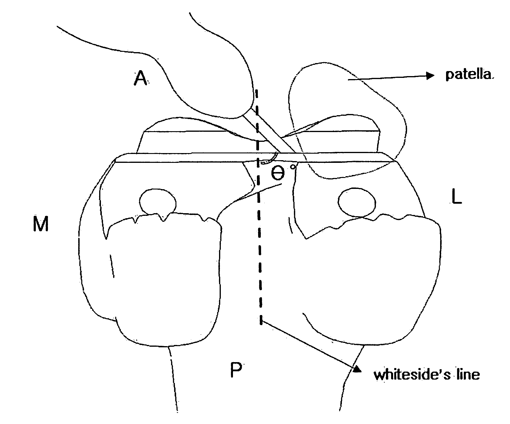 Method and system for cutting knee joint using robot