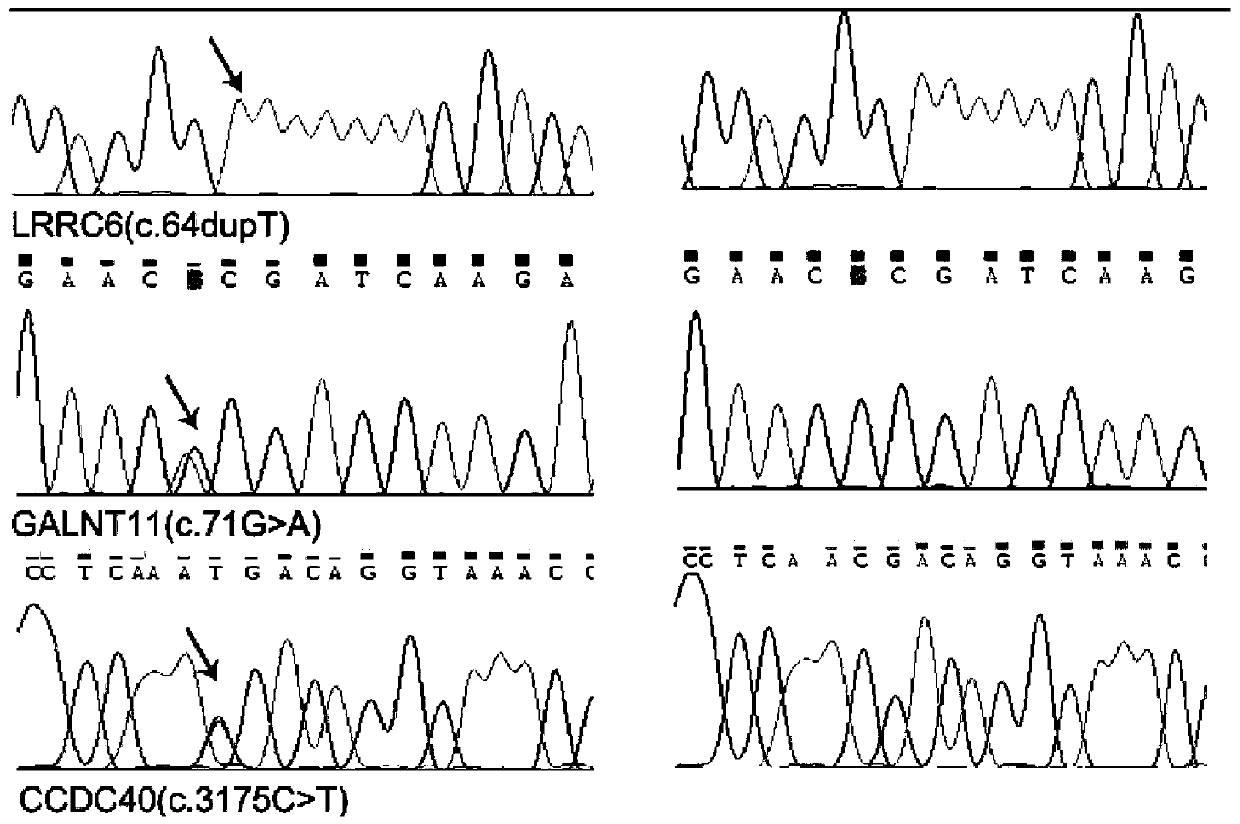 Gene panel kit of Immotile cilia syndrome and application of gene panel kit