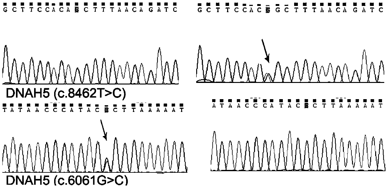 Gene panel kit of Immotile cilia syndrome and application of gene panel kit