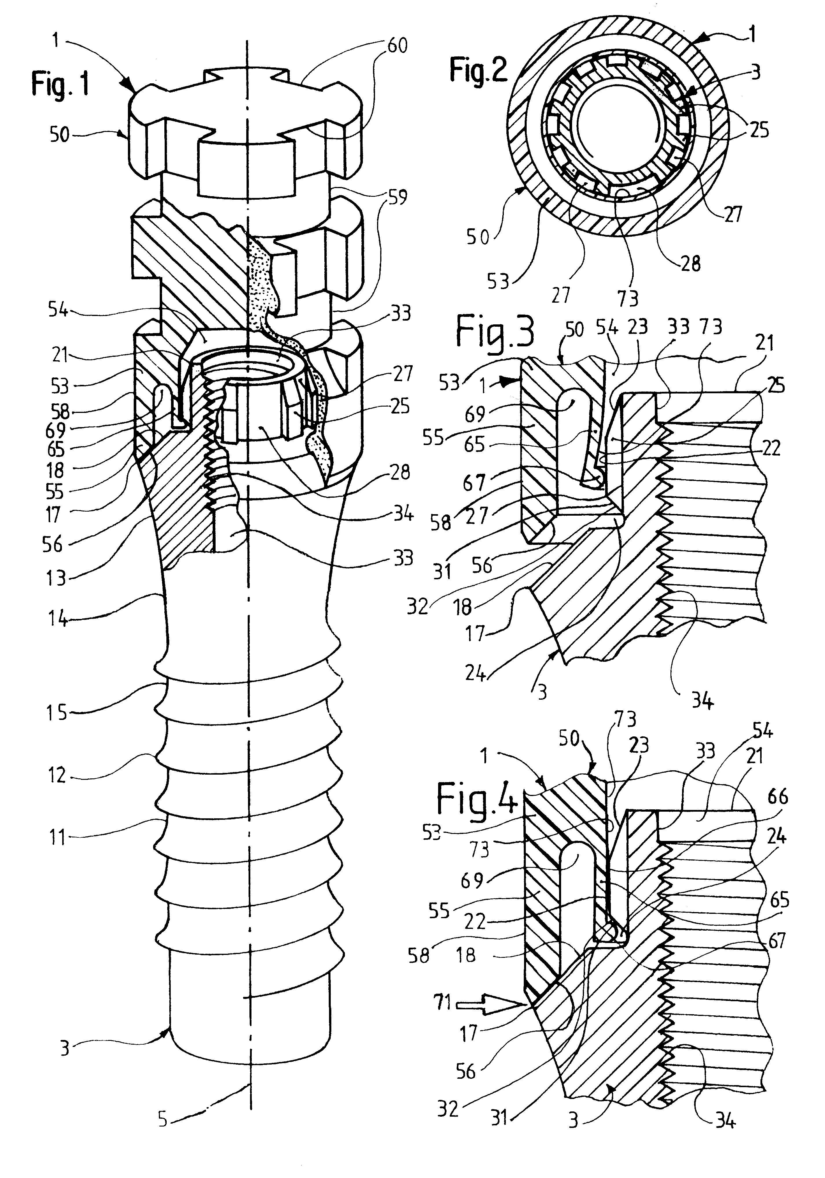 Device for forming a dental prosthesis
