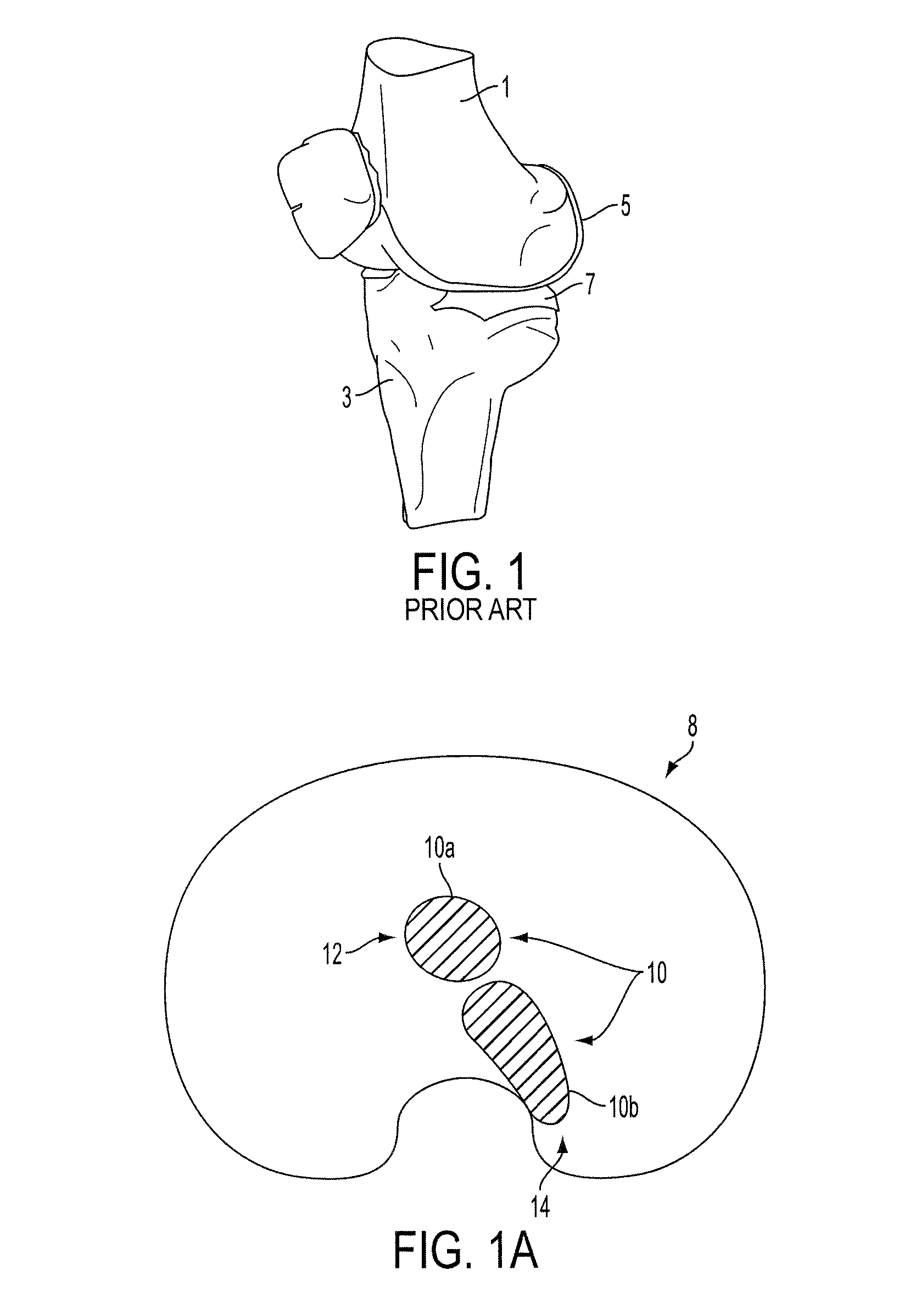 Methods and devices for knee joint replacement with anterior cruciate ligament substitution