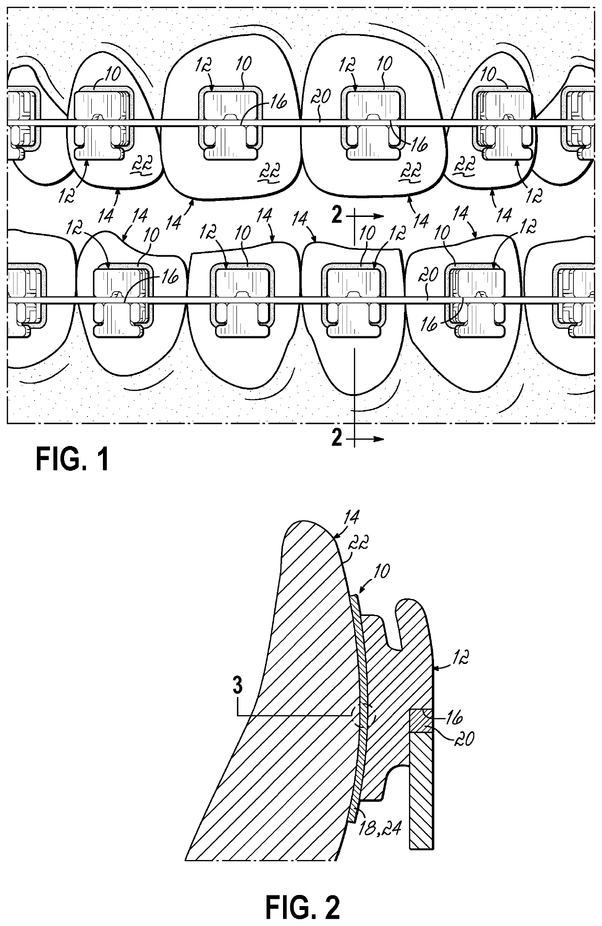 Orthodontic adhesives and methods of using same