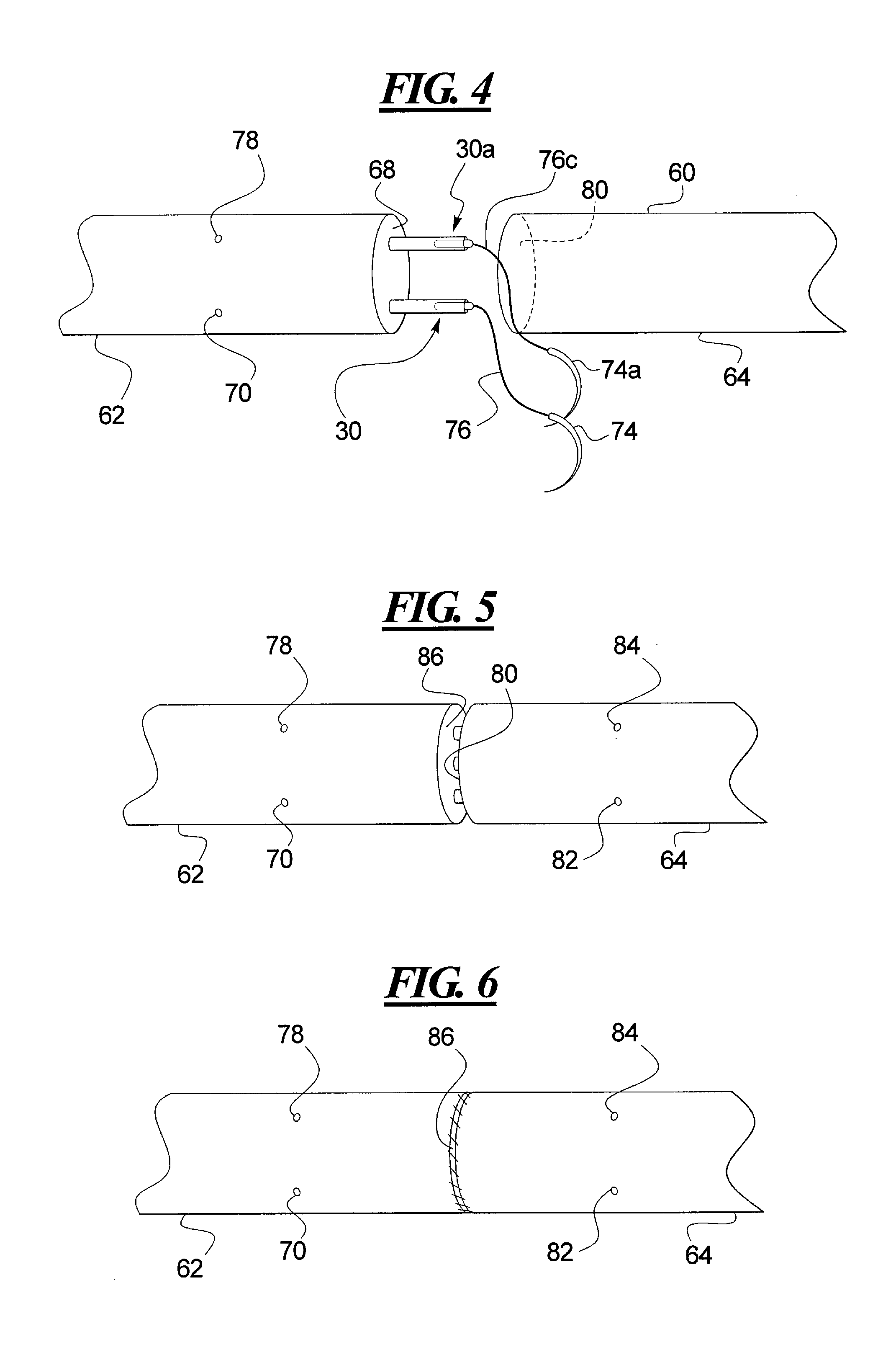 Tendon repair apparatus and method