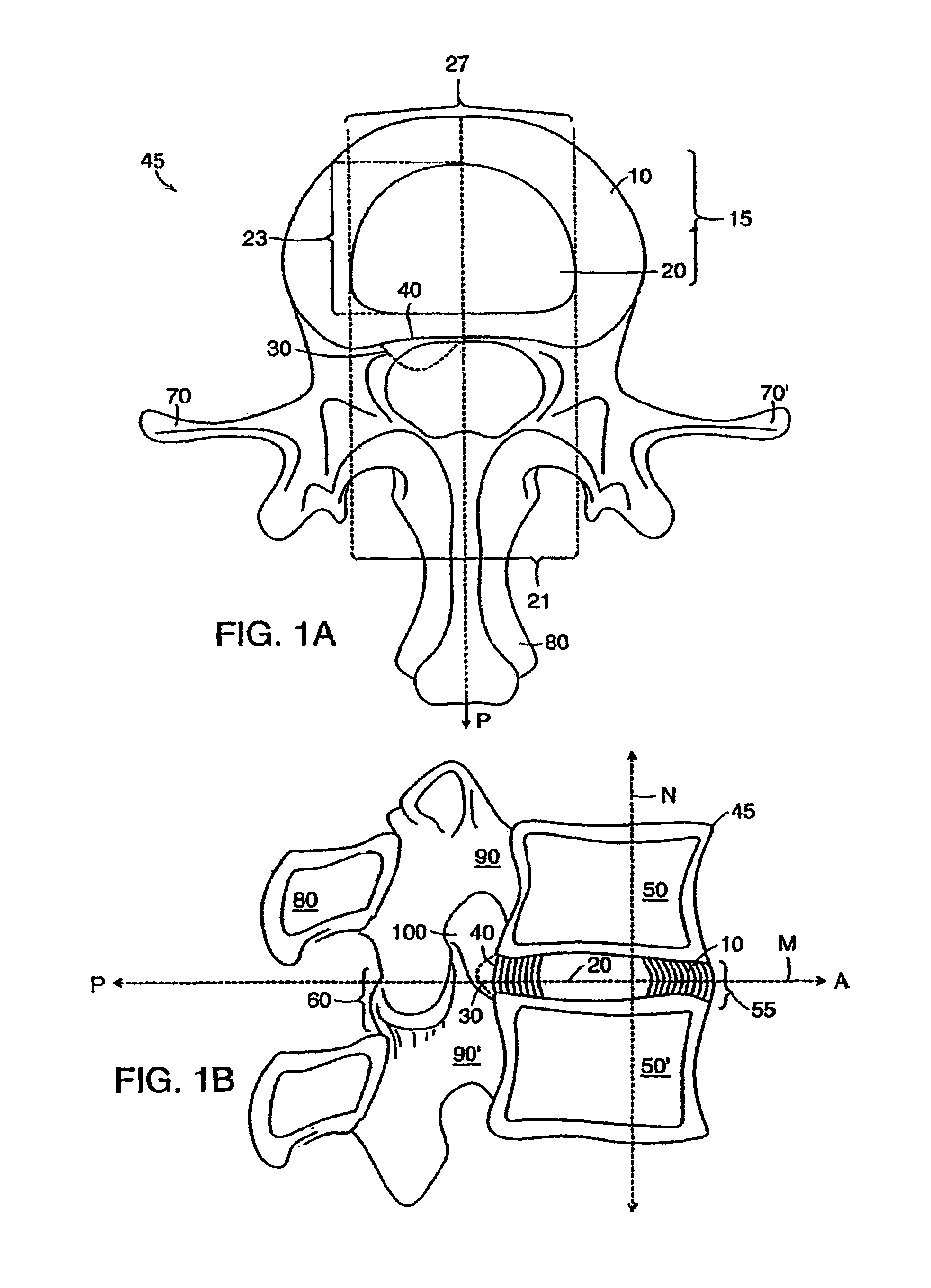 Stabilized intervertebral disc barrier