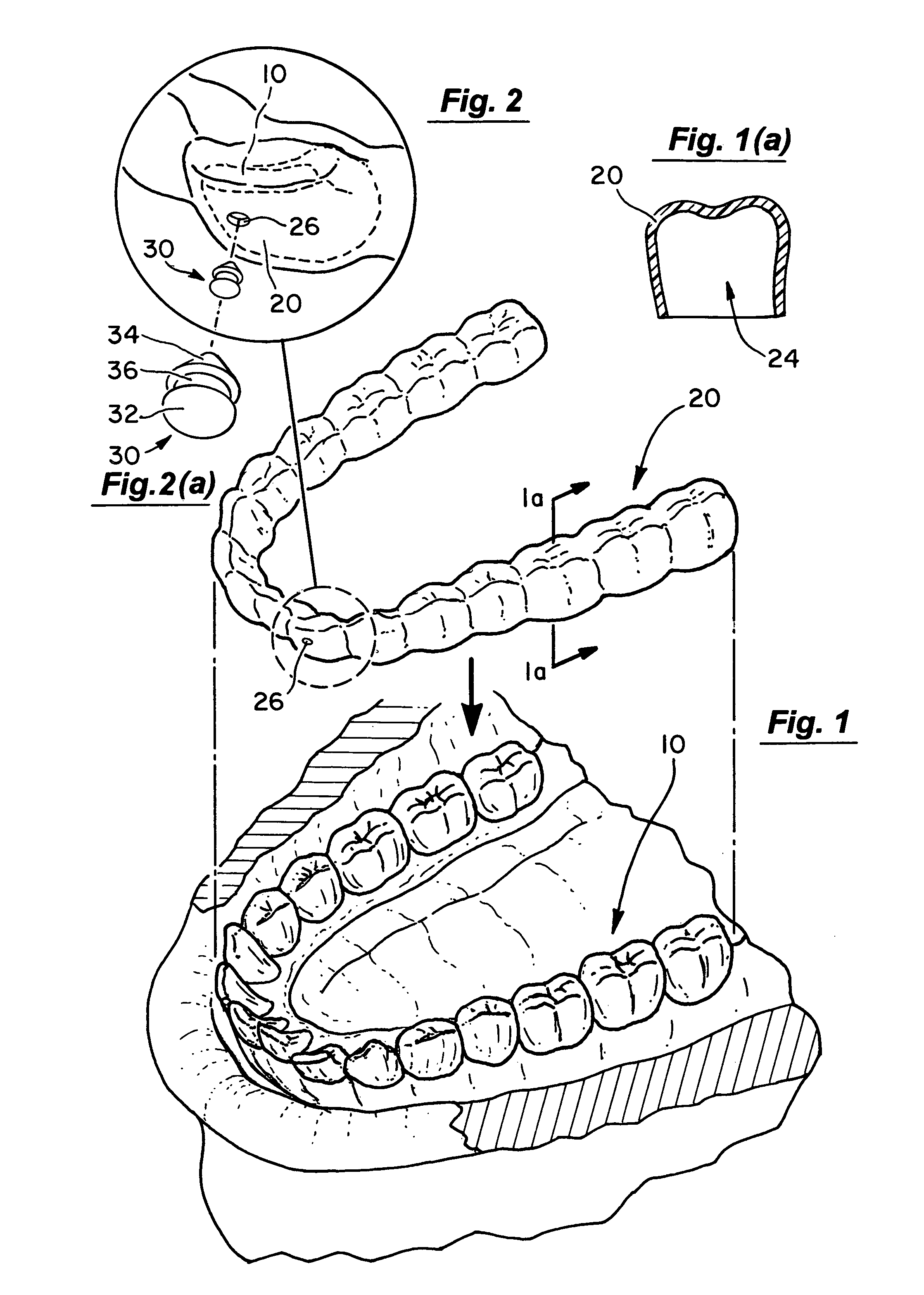 Automated method for producing improved orthodontic aligners