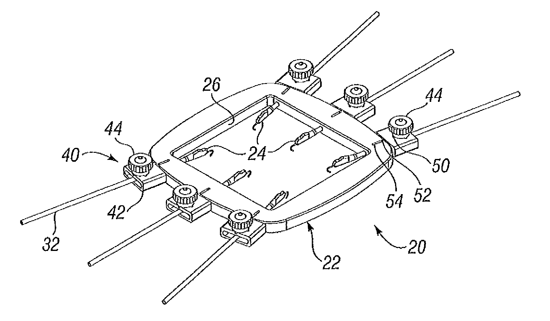 Skin Tensioner for Hair Transplantation