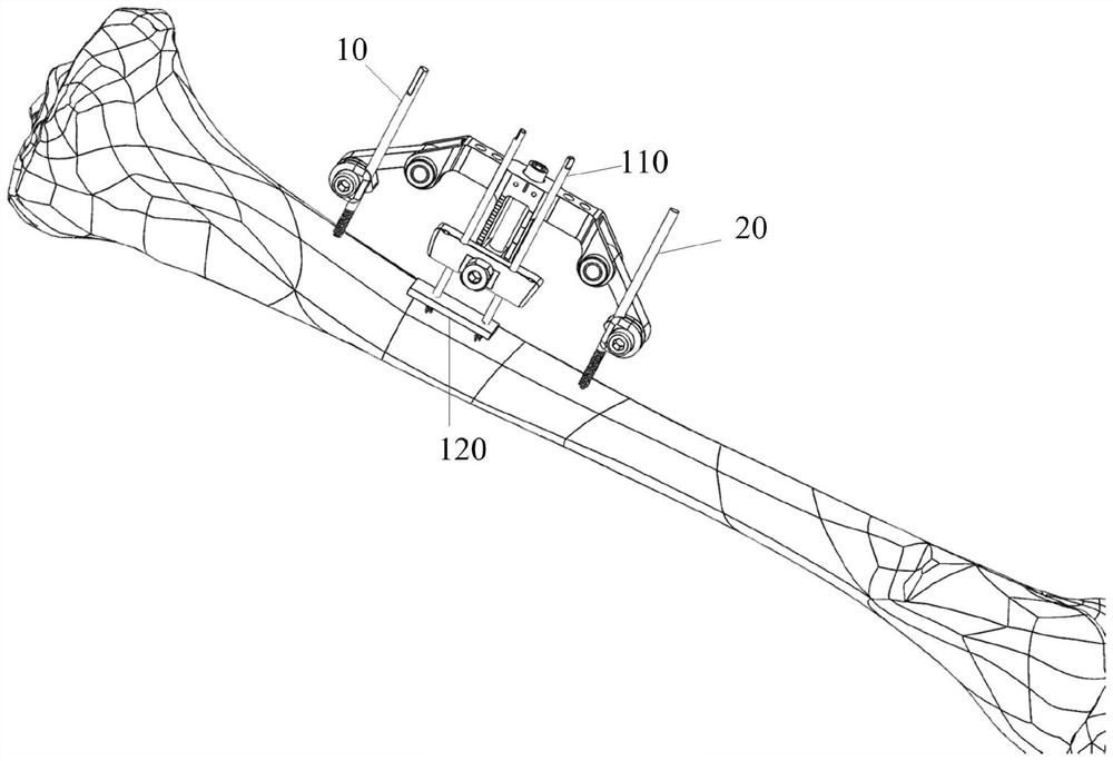 Transverse bone moving device