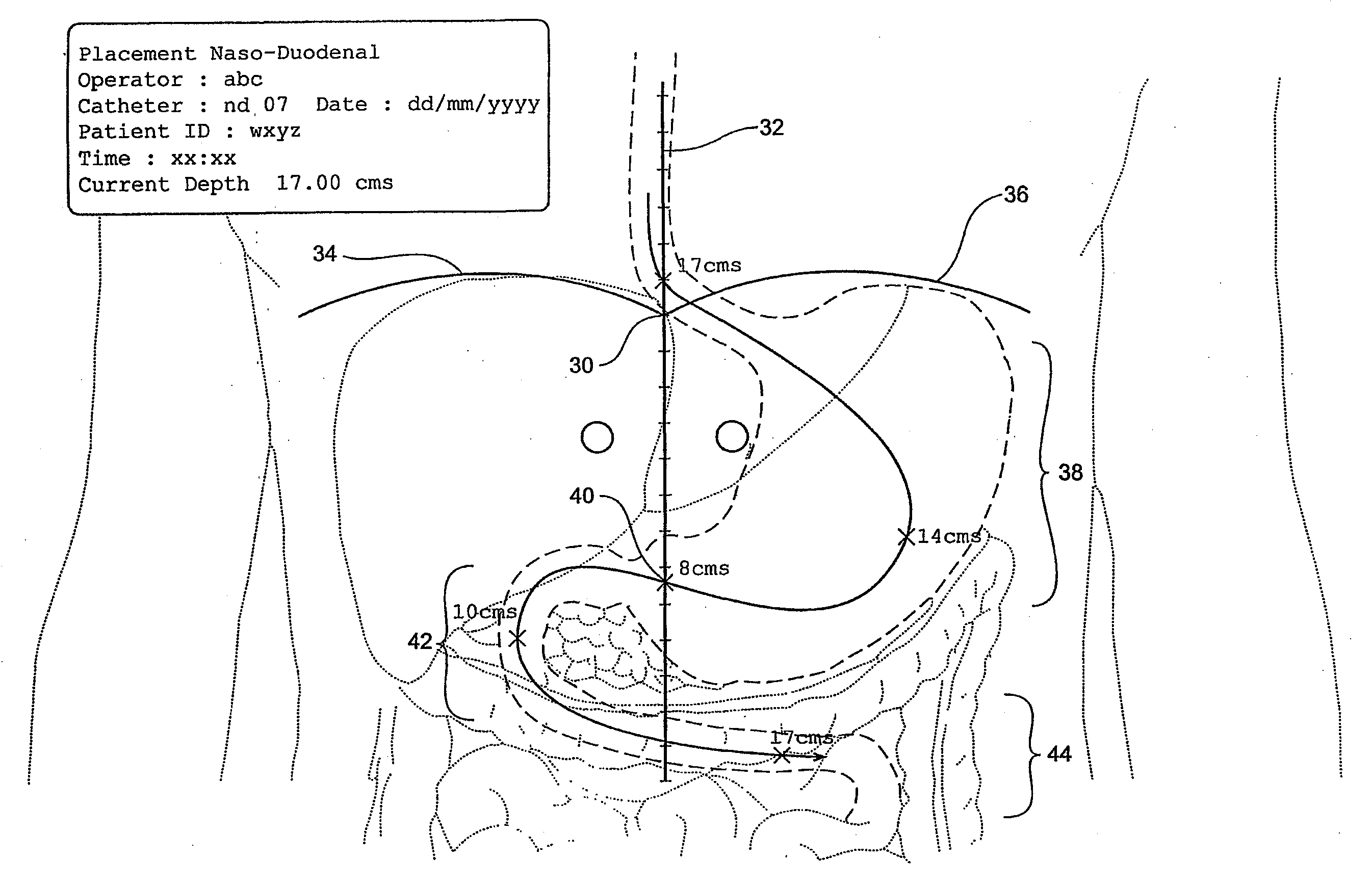 Catheter locator apparatus and method of use