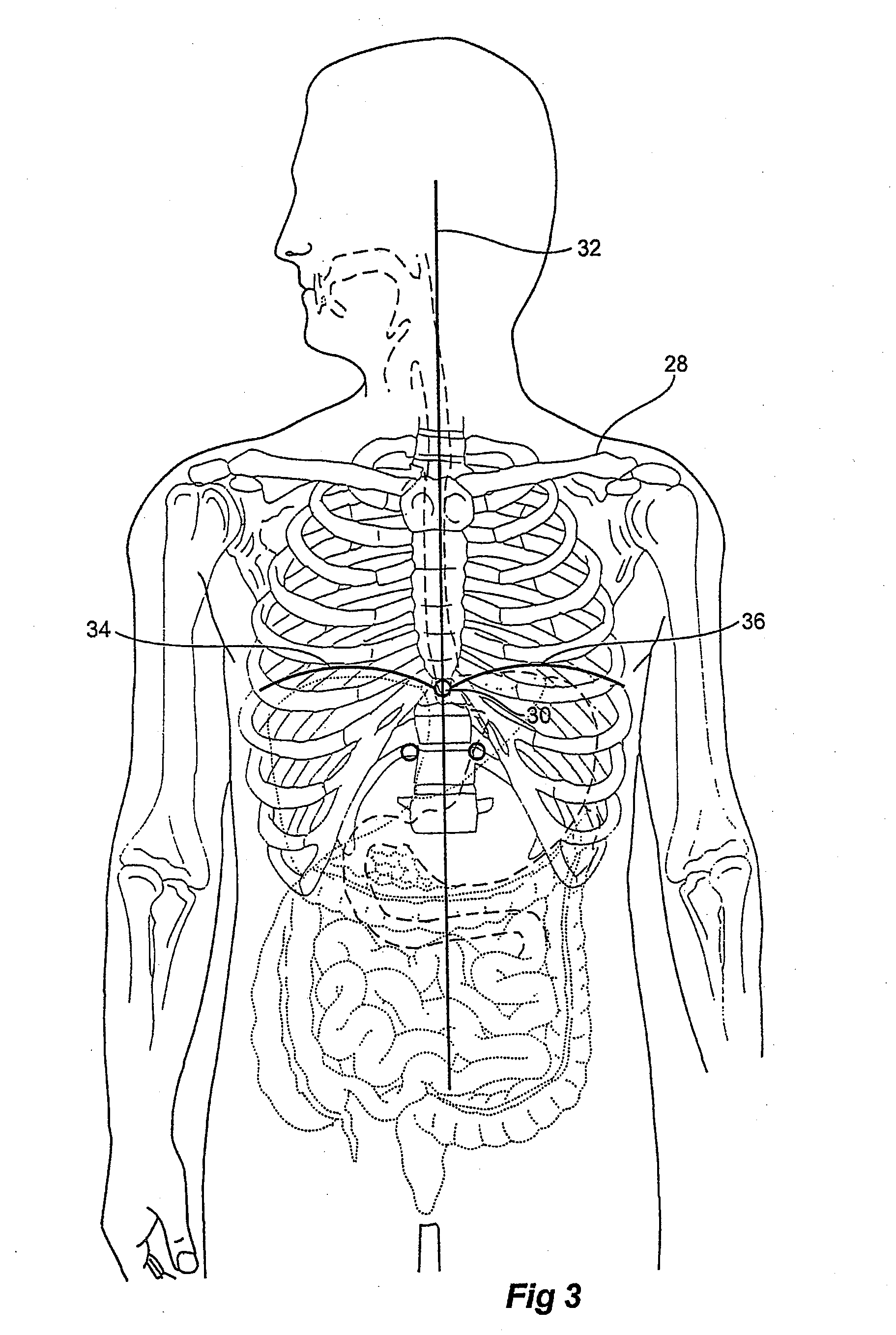 Catheter locator apparatus and method of use