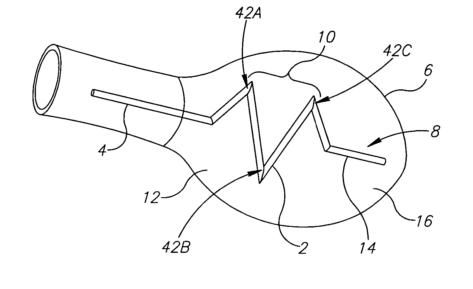 Ventricular injection catheter