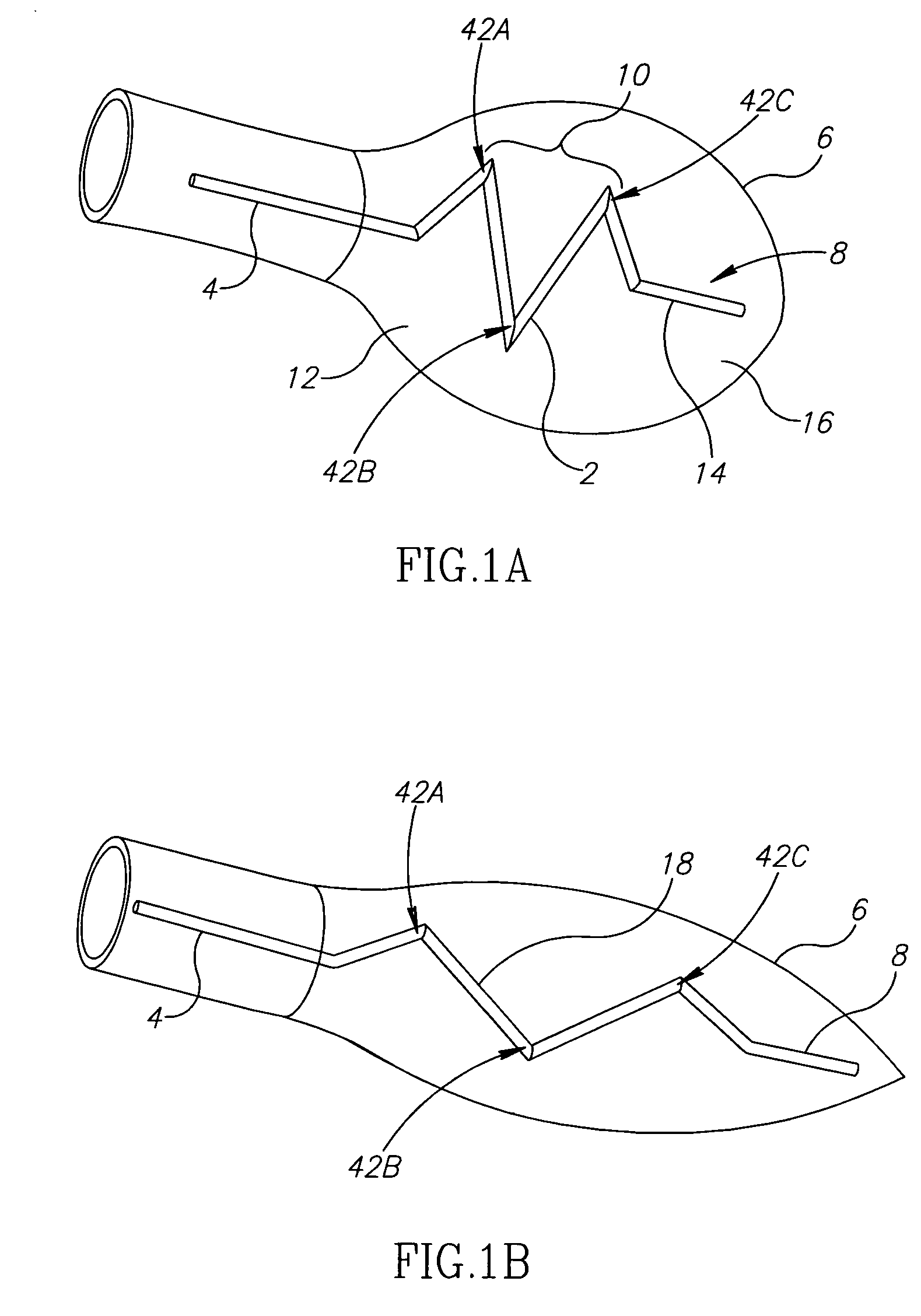 Ventricular injection catheter