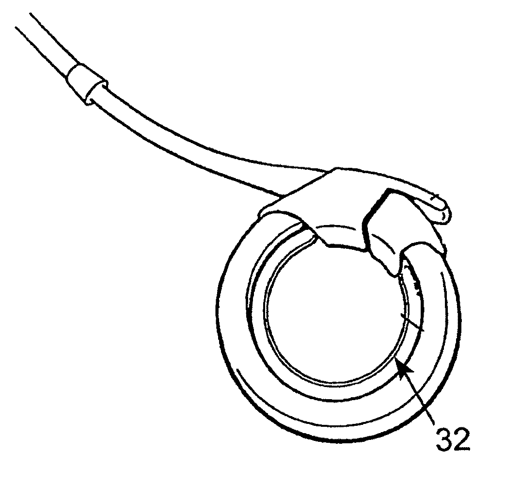 Releasably-securable one-piece adjustable gastric band