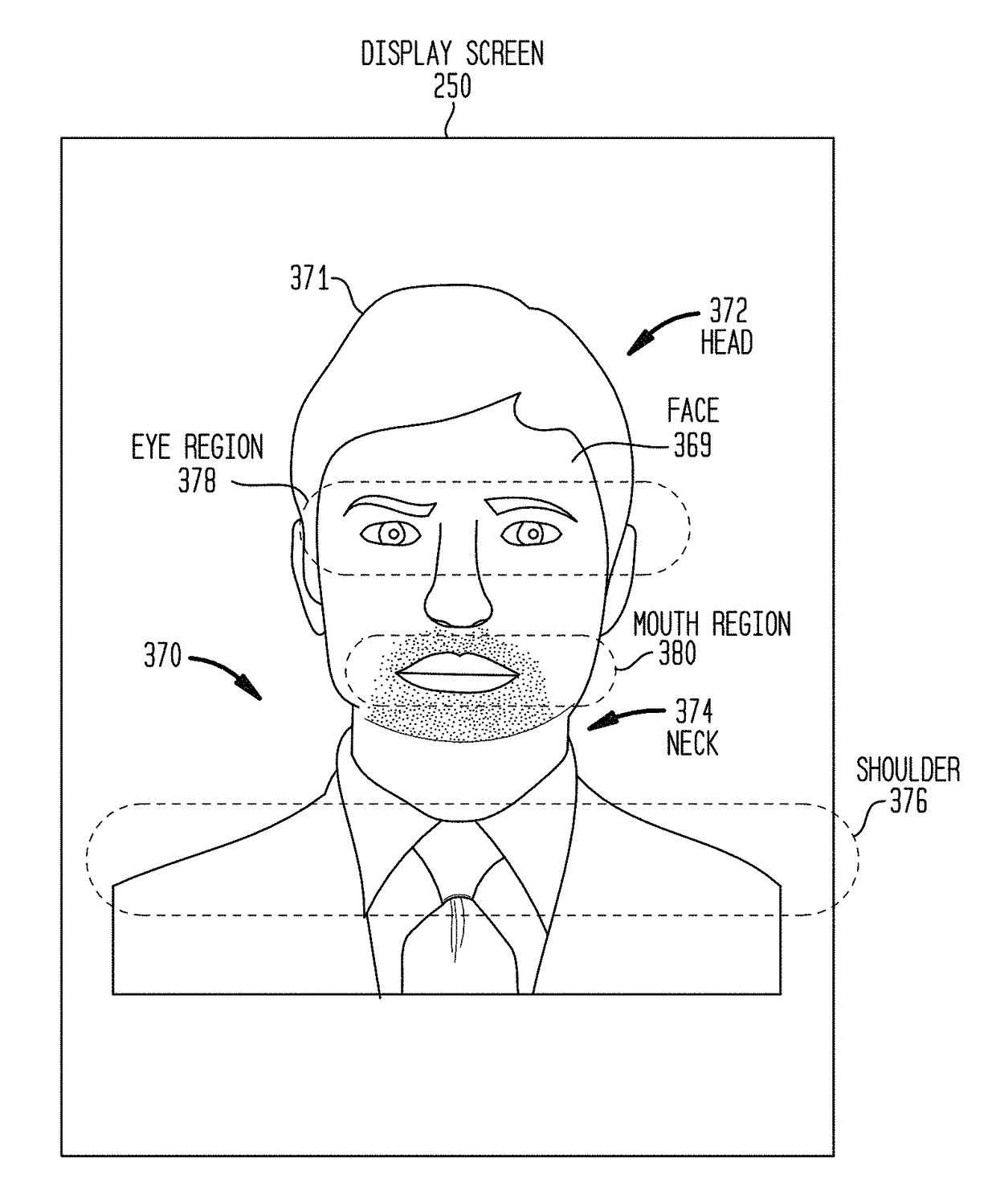 Tonal deafness compensation in an auditory prosthesis system