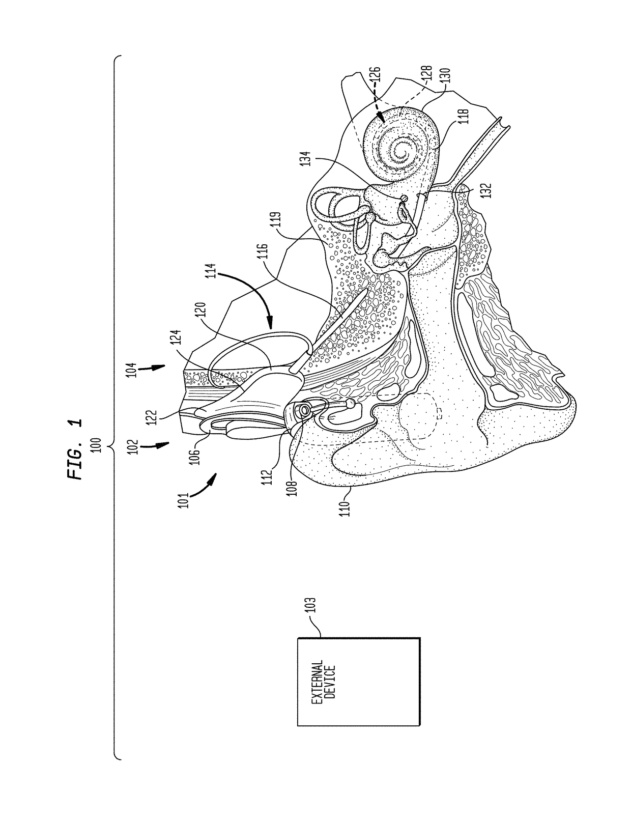 Tonal deafness compensation in an auditory prosthesis system