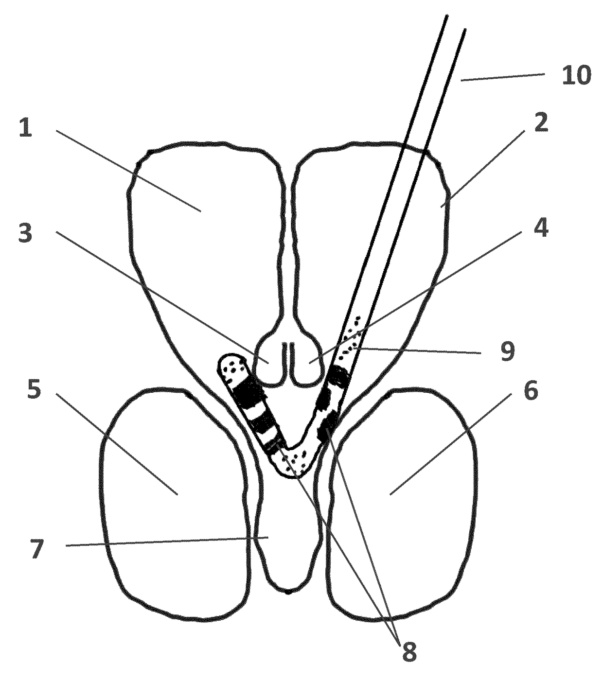 Methods and systems for intraventricular brain stimulation