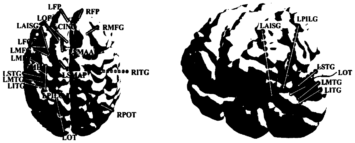 Detection method for epileptic seizure signals based on BNI