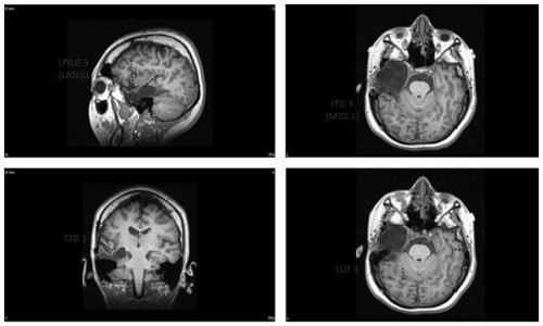 Detection method for epileptic seizure signals based on BNI