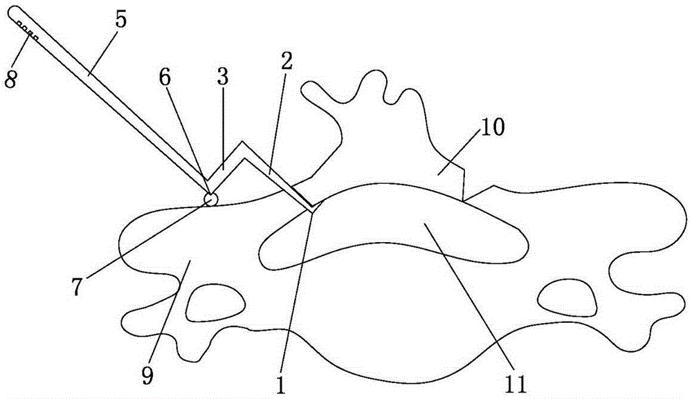 Opener for vertebral plate