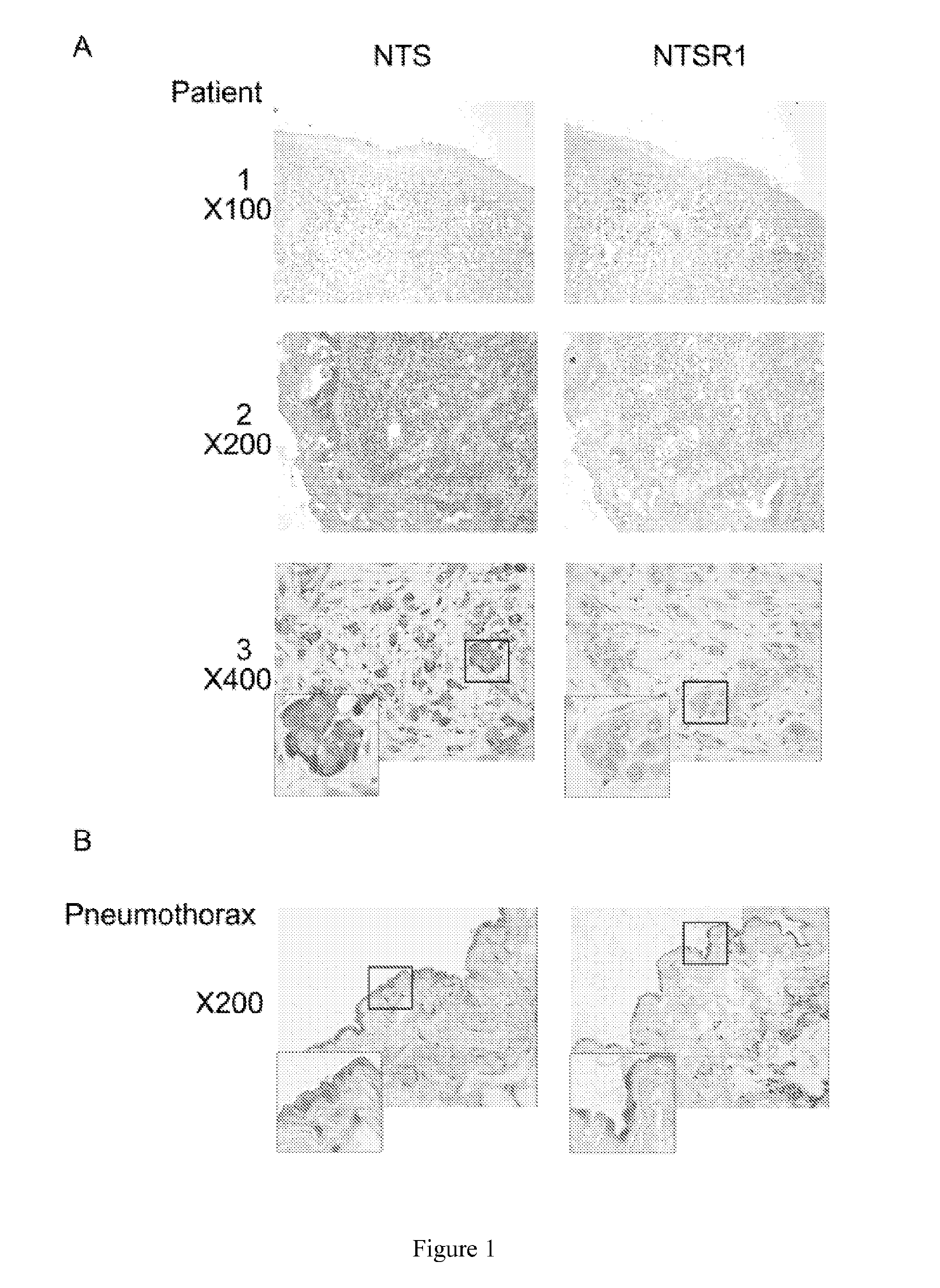 Methods for the Treatment and the Prognostic Assessment of Malignant Pleural Mesothelioma